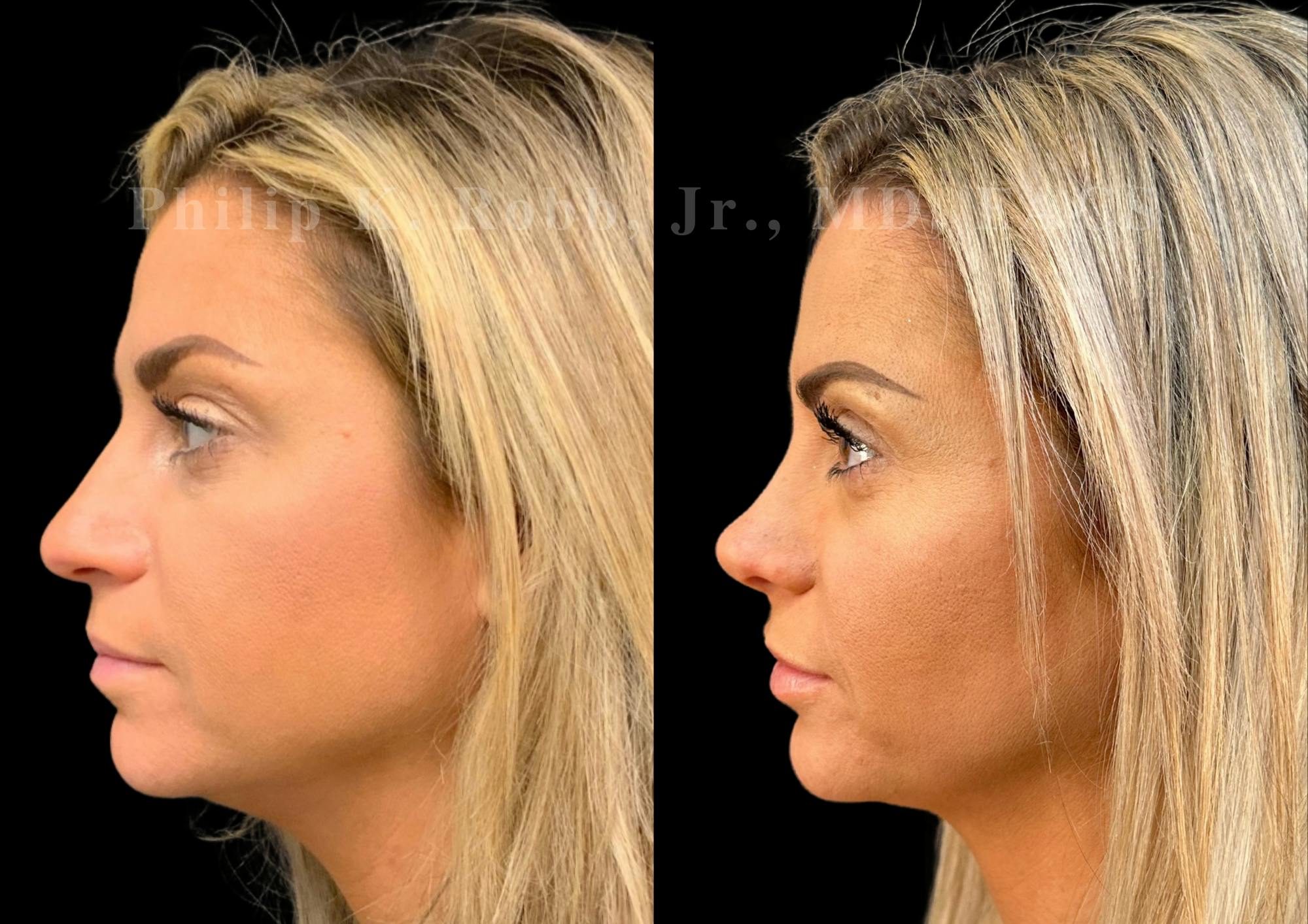 Ultrasonic Rhinoplasty Before & After Gallery - Patient 129608 - Image 5