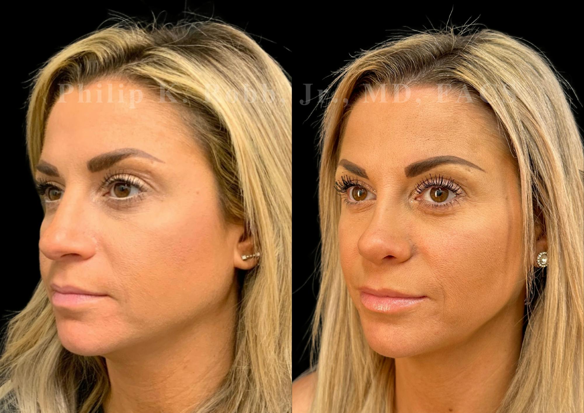 Ultrasonic Rhinoplasty Before & After Gallery - Patient 129608 - Image 4