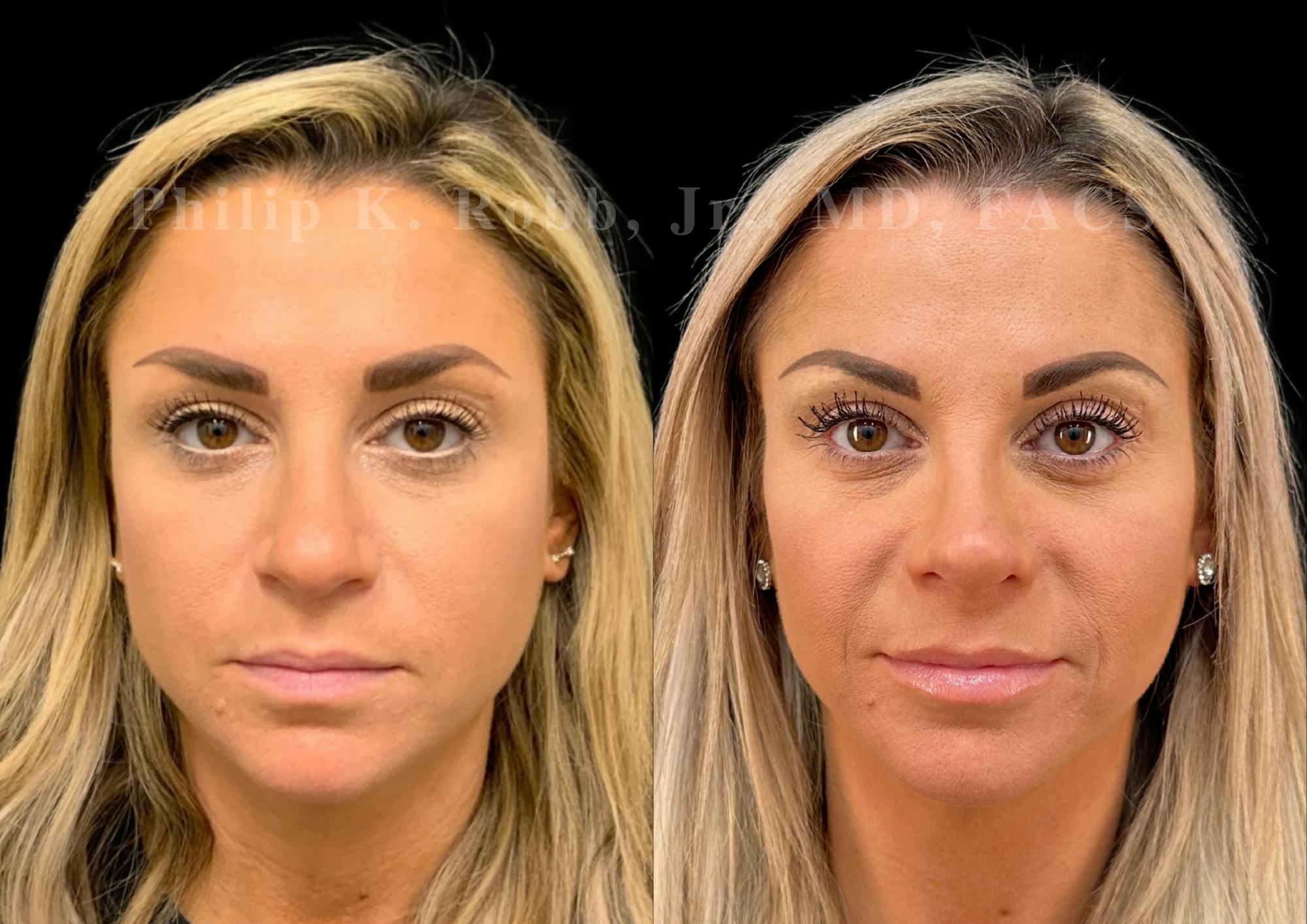 Ultrasonic Rhinoplasty Before & After Gallery - Patient 129608 - Image 3