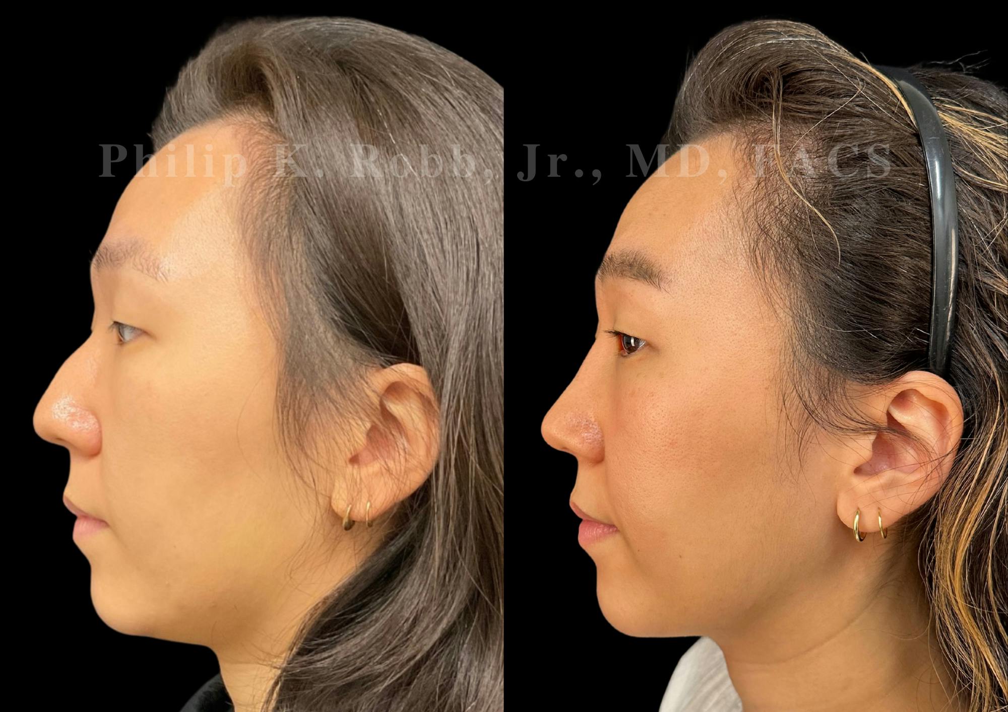 Ultrasonic Rhinoplasty Before & After Gallery - Patient 168693 - Image 5