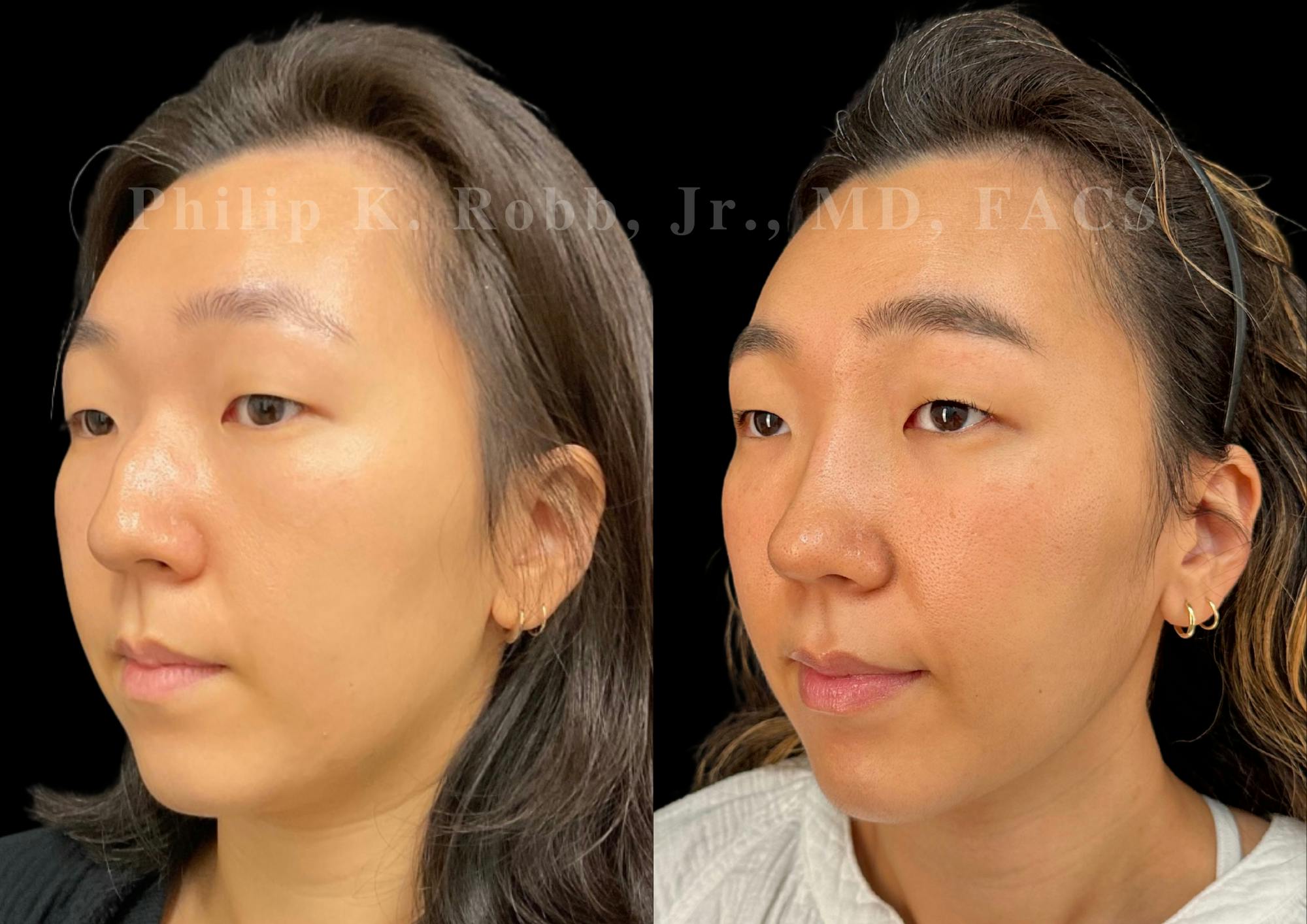 Ultrasonic Rhinoplasty Before & After Gallery - Patient 168693 - Image 4