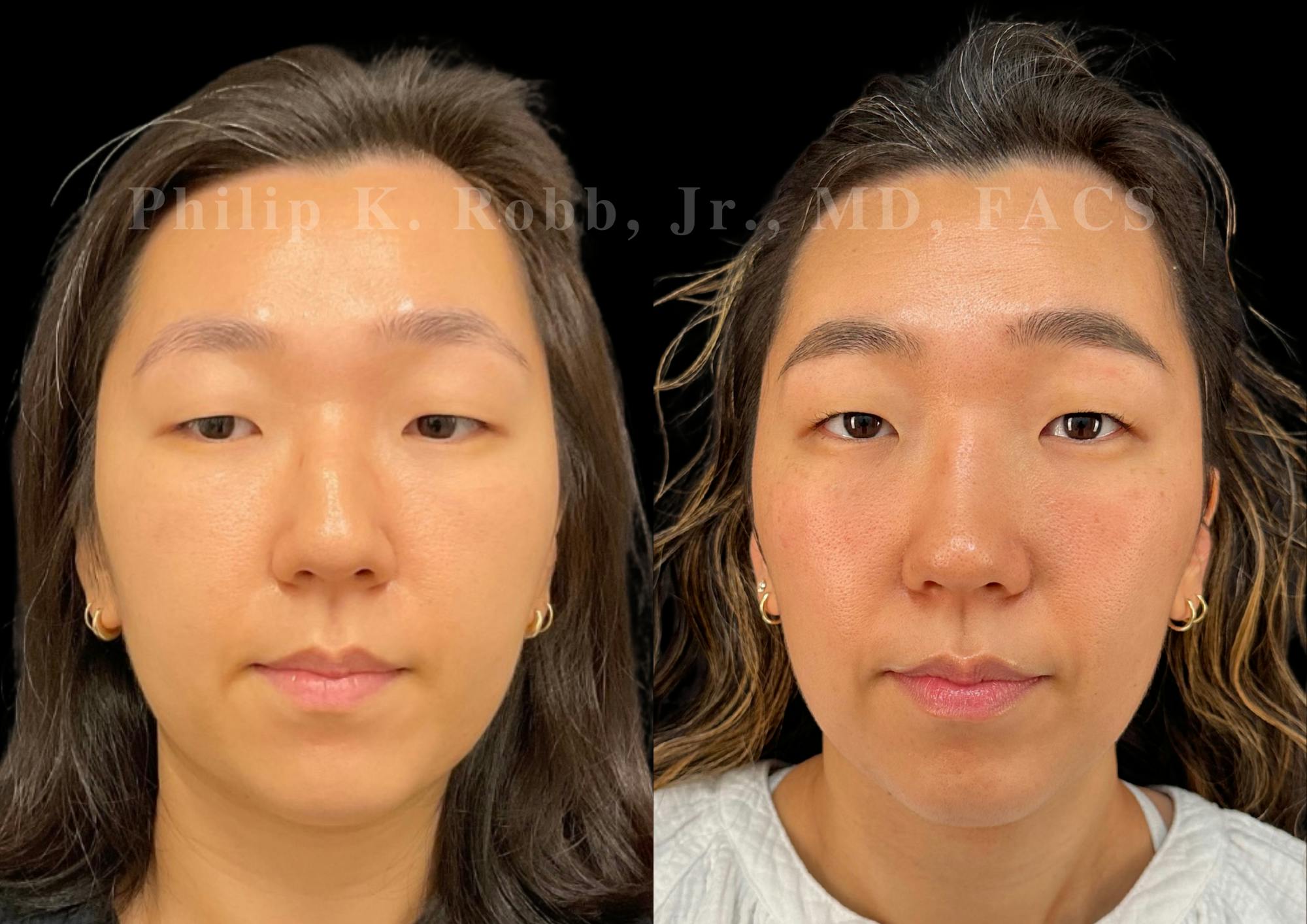Ultrasonic Rhinoplasty Before & After Gallery - Patient 168693 - Image 3