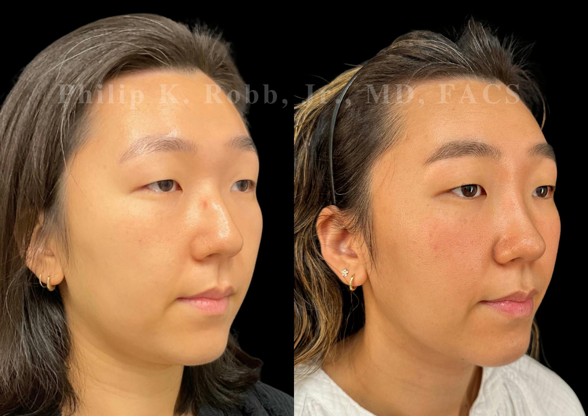 Ultrasonic Rhinoplasty Before & After Gallery - Patient 168693 - Image 2
