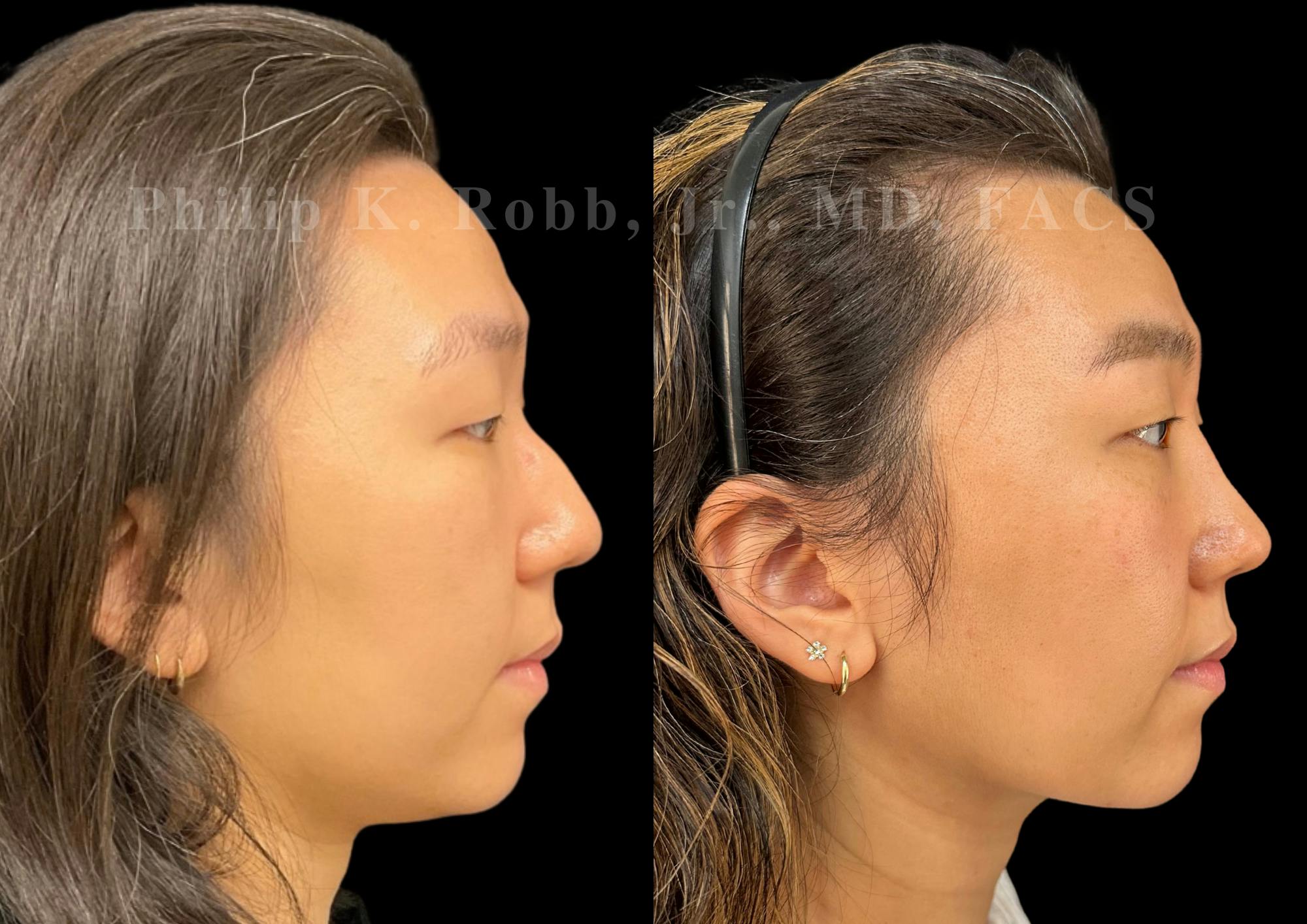 Ultrasonic Rhinoplasty Before & After Gallery - Patient 168693 - Image 1