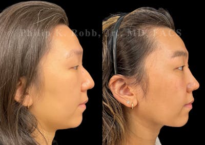 Ultrasonic Rhinoplasty Before & After Gallery - Patient 168693 - Image 1