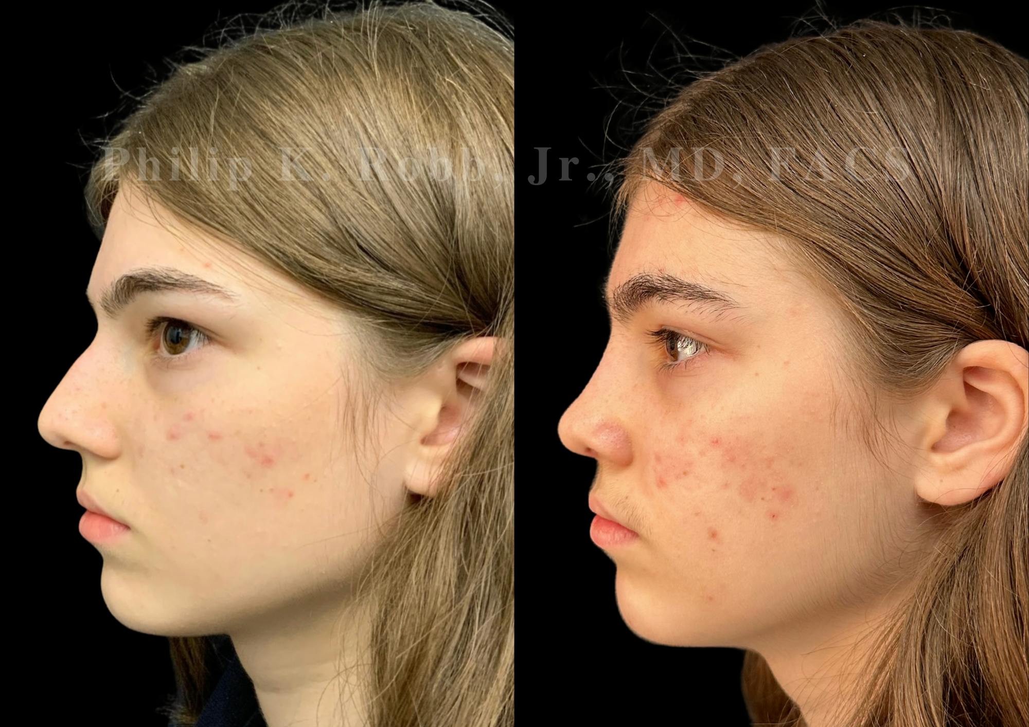 Ultrasonic Rhinoplasty Before & After Gallery - Patient 535345 - Image 5