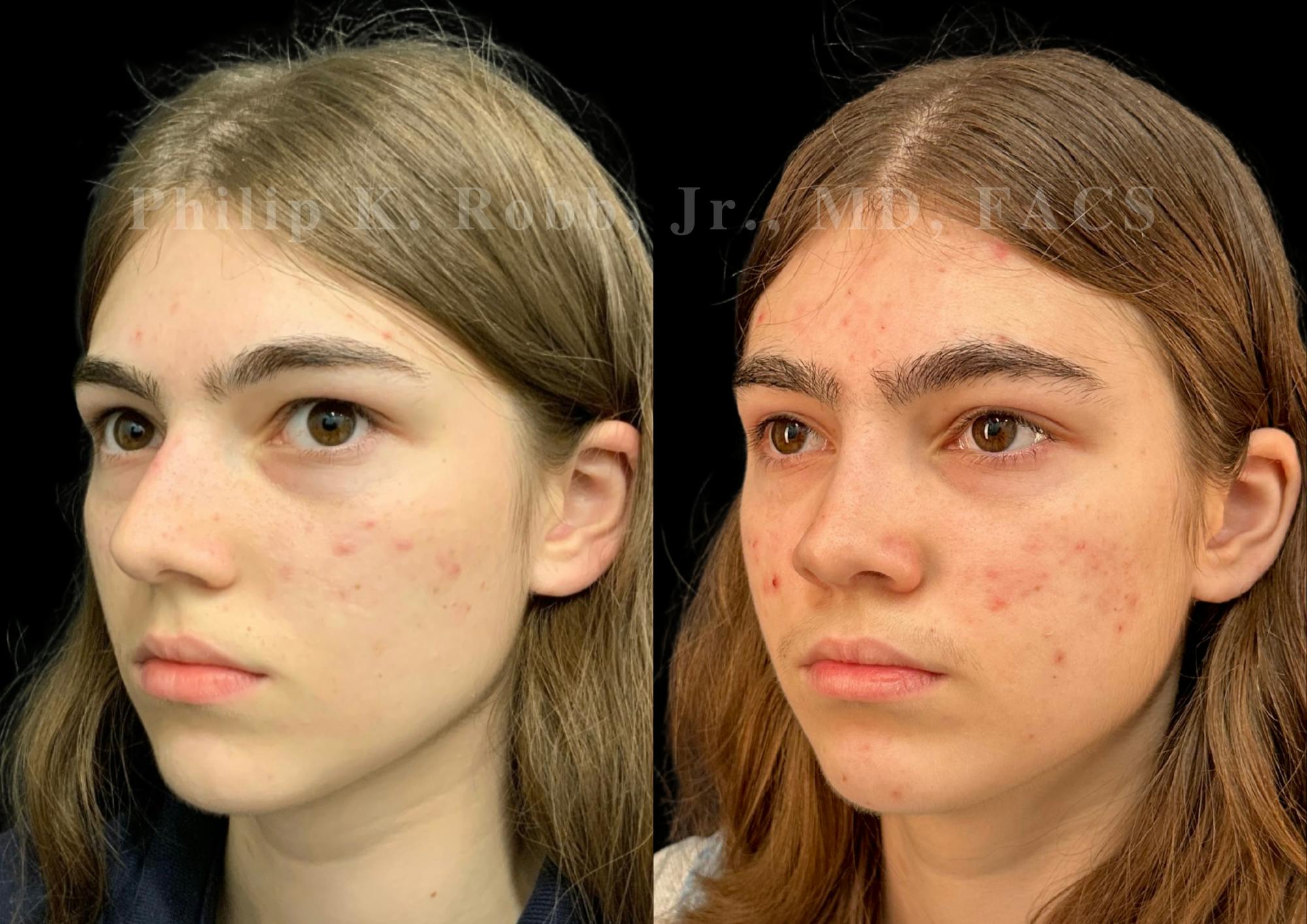 Ultrasonic Rhinoplasty Before & After Gallery - Patient 535345 - Image 4