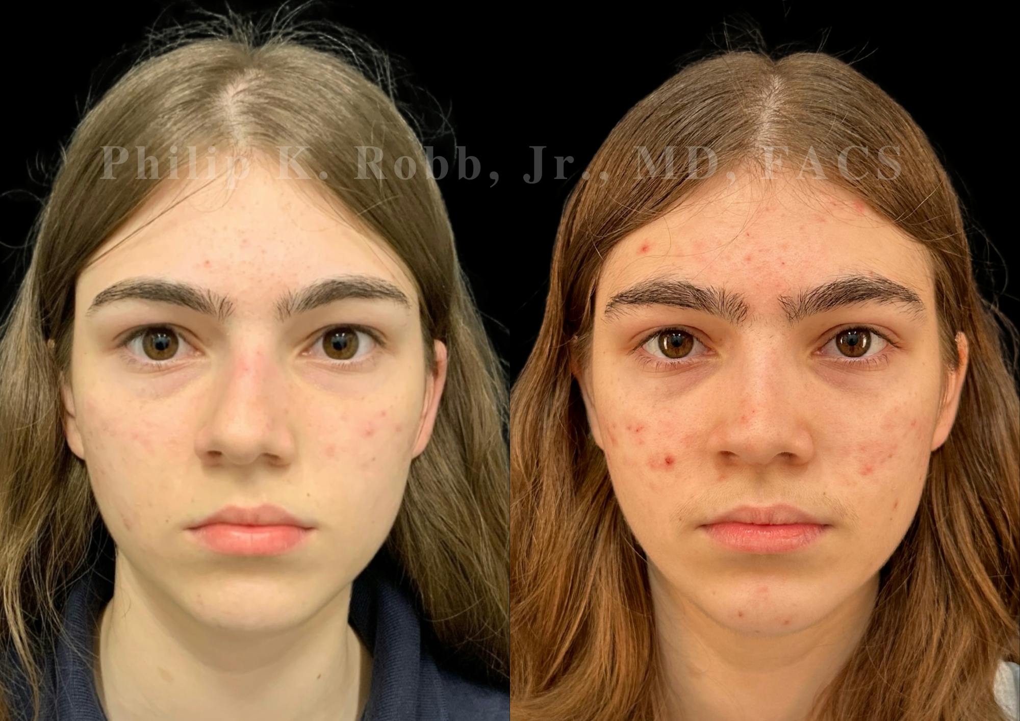 Ultrasonic Rhinoplasty Before & After Gallery - Patient 535345 - Image 3