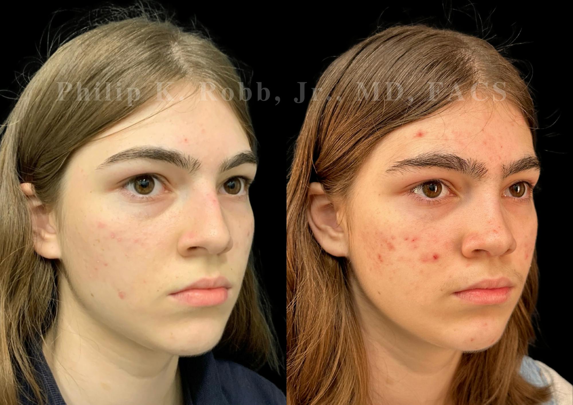 Ultrasonic Rhinoplasty Before & After Gallery - Patient 535345 - Image 2