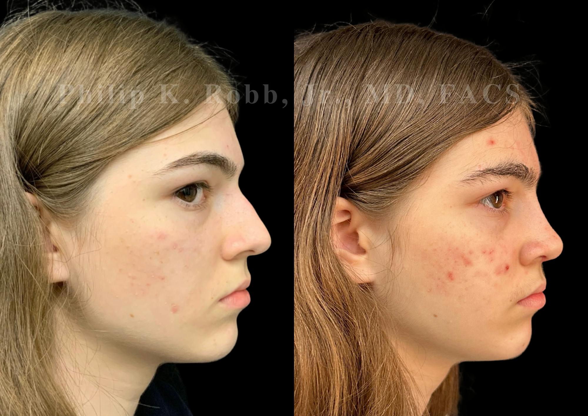 Ultrasonic Rhinoplasty Before & After Gallery - Patient 535345 - Image 1
