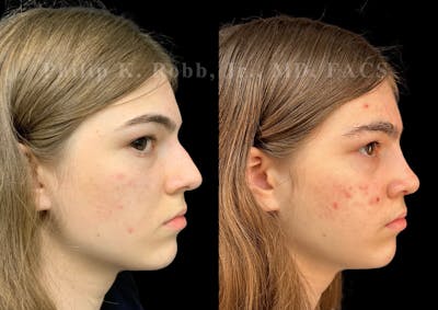 Ultrasonic Rhinoplasty Before & After Gallery - Patient 535345 - Image 1