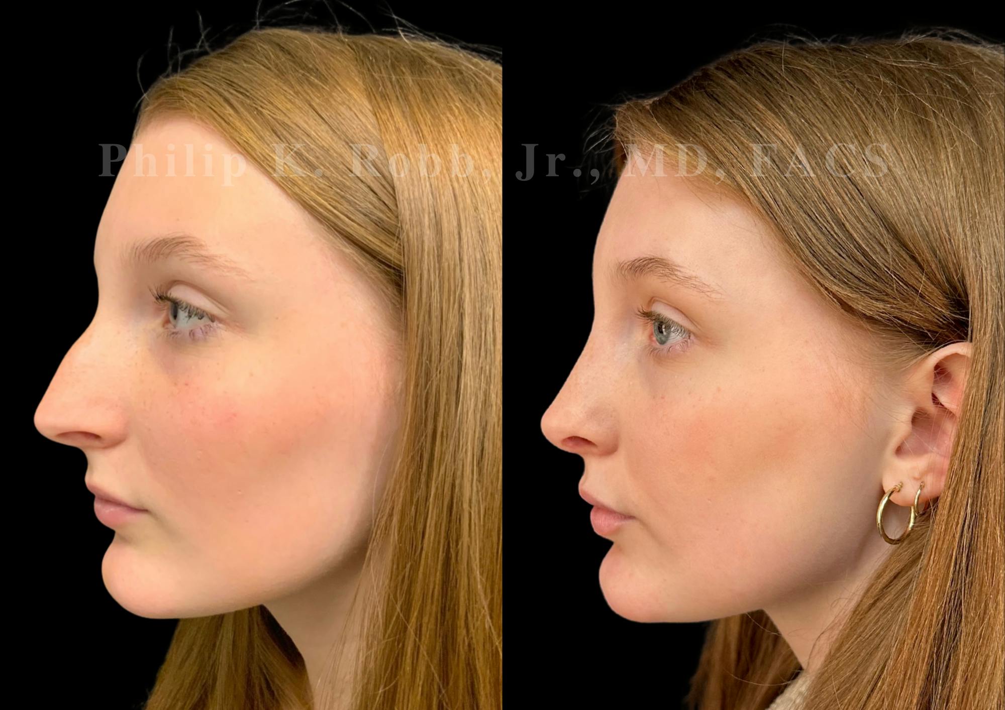 Ultrasonic Rhinoplasty Before & After Gallery - Patient 993050 - Image 5