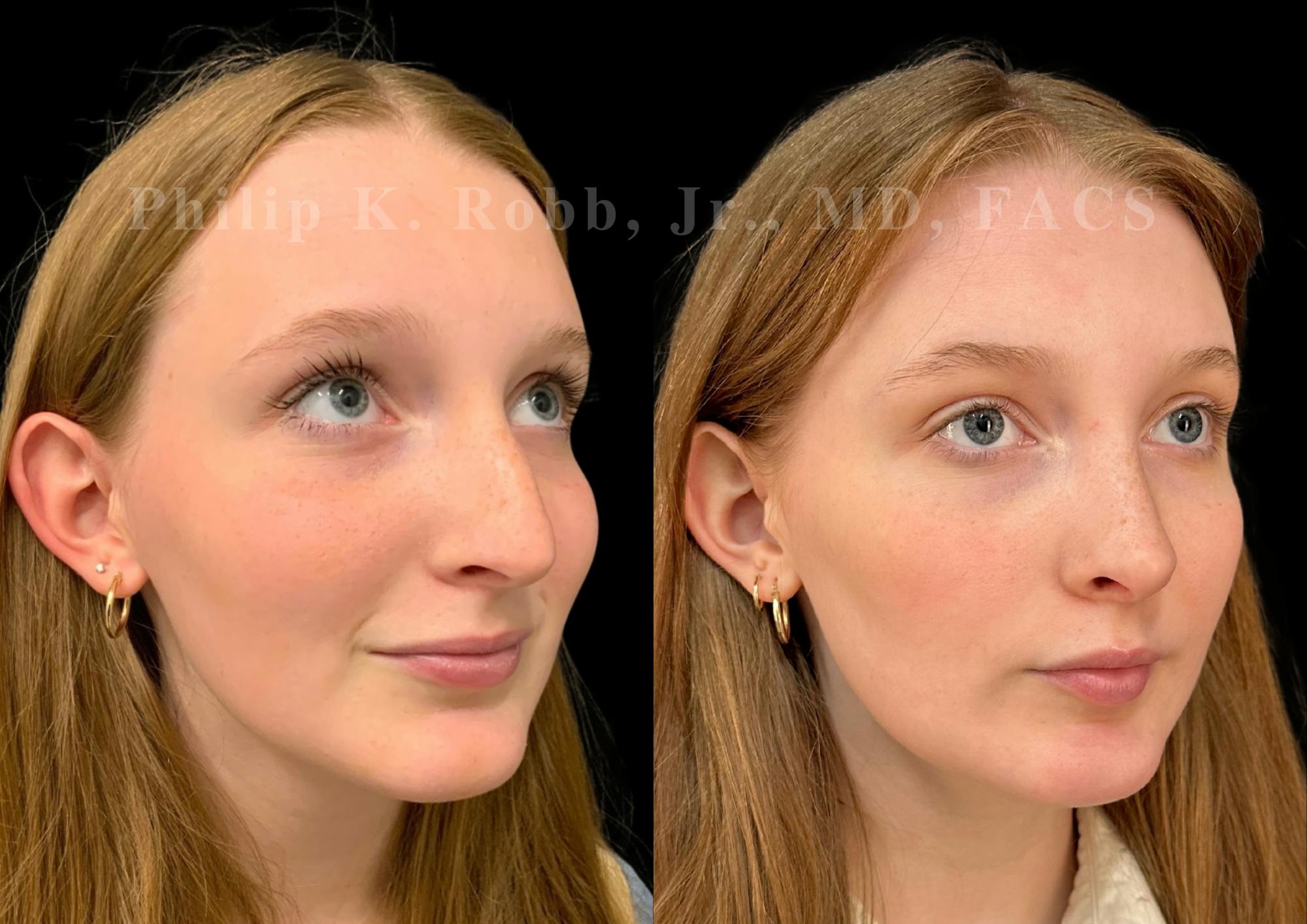 Ultrasonic Rhinoplasty Before & After Gallery - Patient 993050 - Image 2