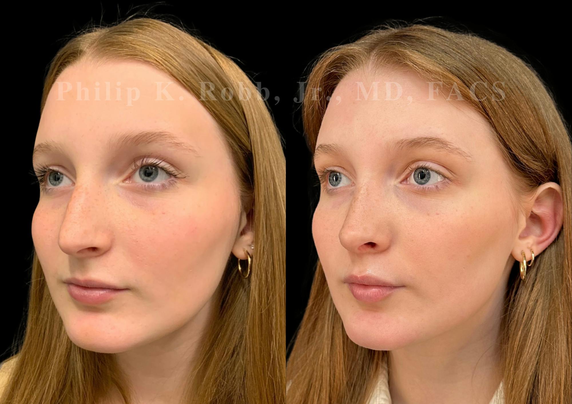 Ultrasonic Rhinoplasty Before & After Gallery - Patient 993050 - Image 4