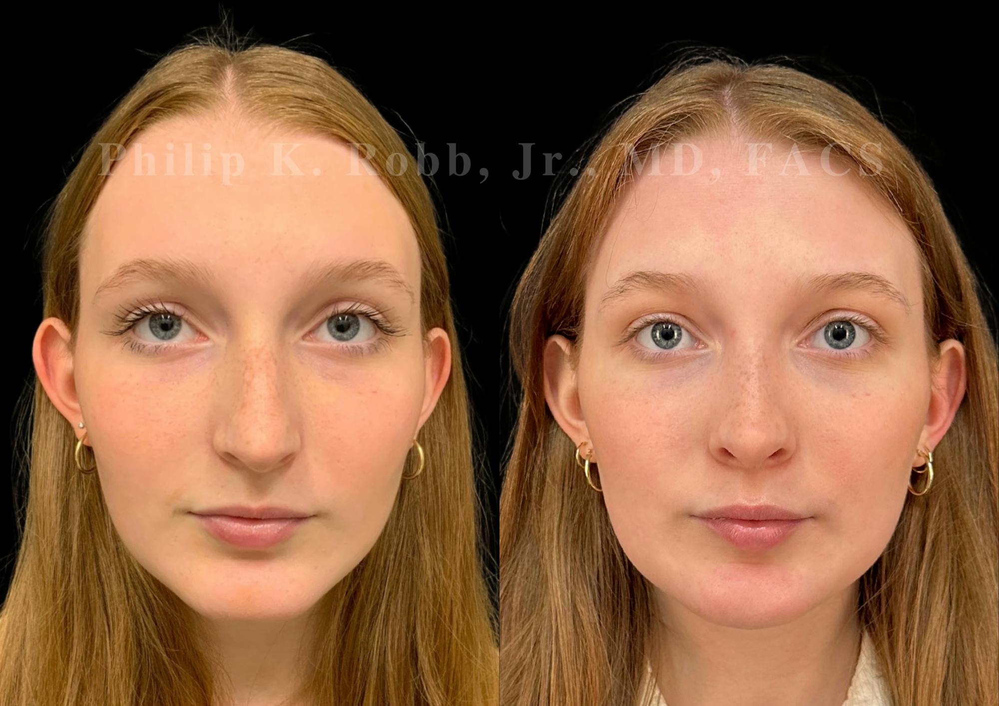 Ultrasonic Rhinoplasty Before & After Gallery - Patient 993050 - Image 3