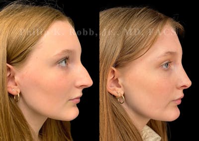 Ultrasonic Rhinoplasty Before & After Gallery - Patient 993050 - Image 1