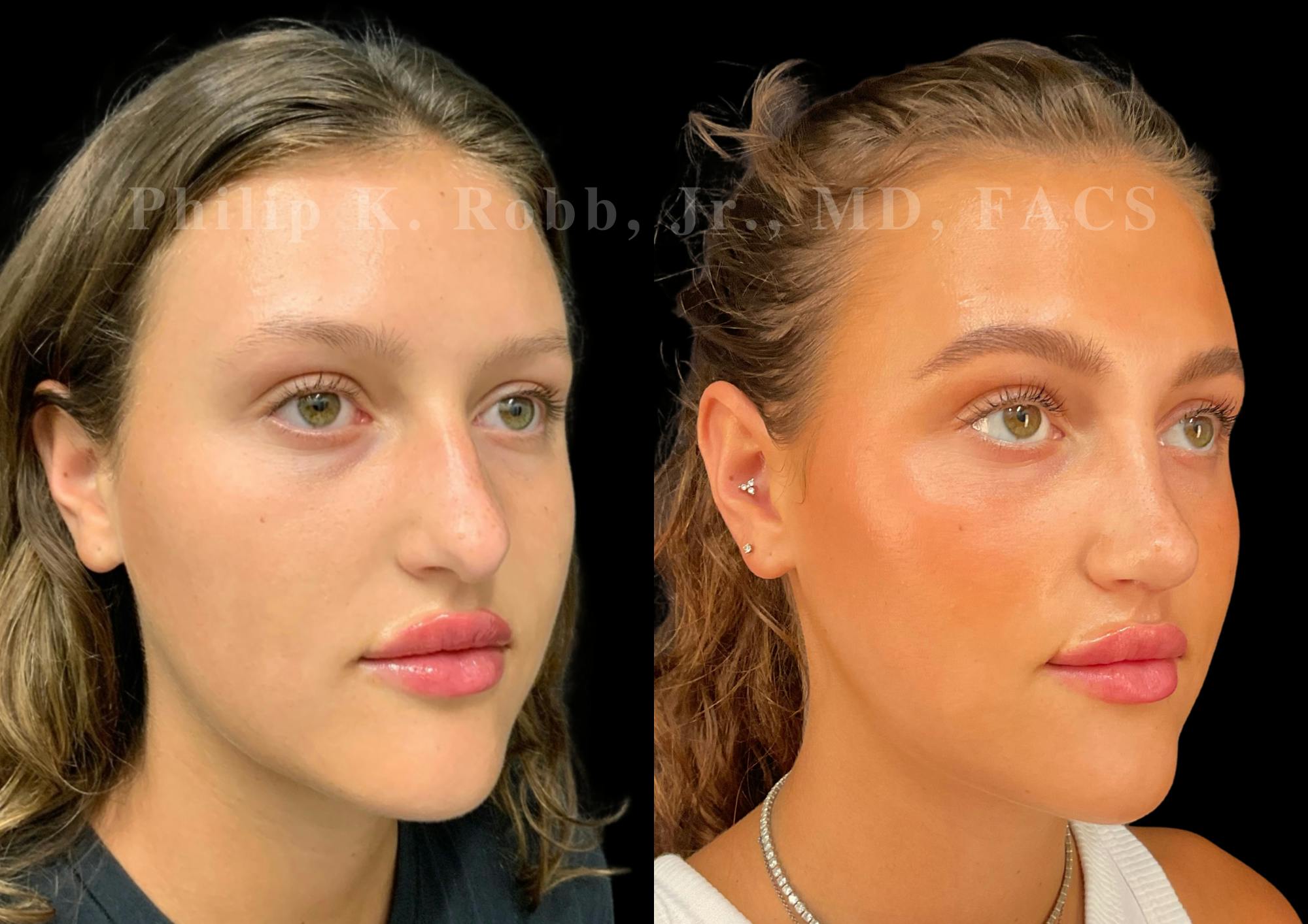 Ultrasonic Rhinoplasty Before & After Gallery - Patient 205439 - Image 2