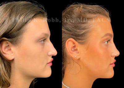 Ultrasonic Rhinoplasty Before & After Gallery - Patient 205439 - Image 1