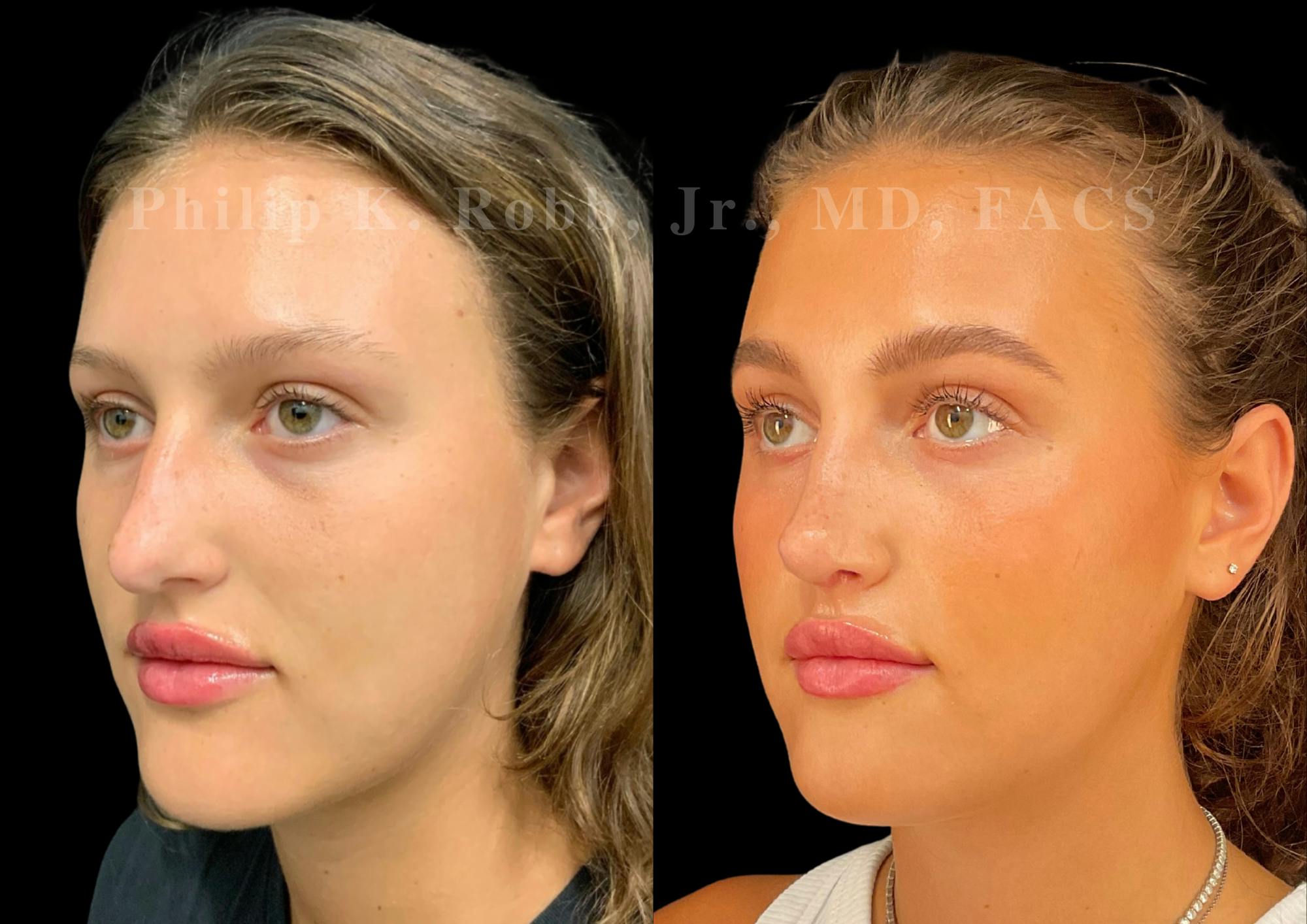 Ultrasonic Rhinoplasty Before & After Gallery - Patient 205439 - Image 4