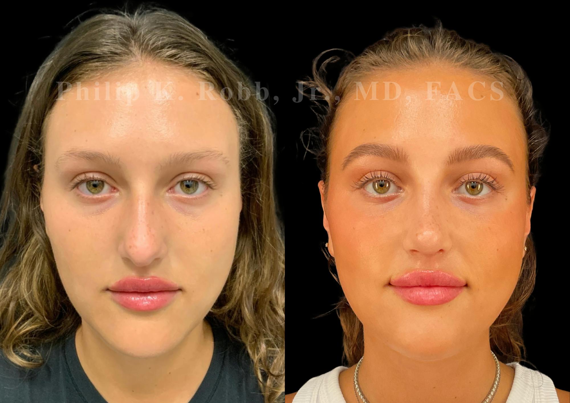 Ultrasonic Rhinoplasty Before & After Gallery - Patient 205439 - Image 3