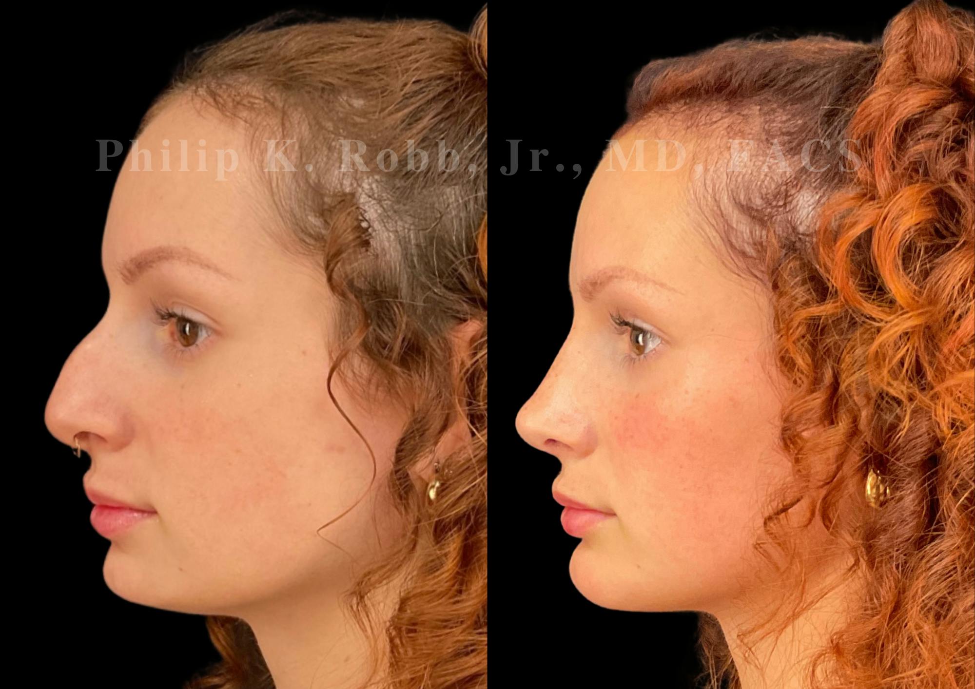 Chin Augmentation Before & After Gallery - Patient 156196 - Image 1