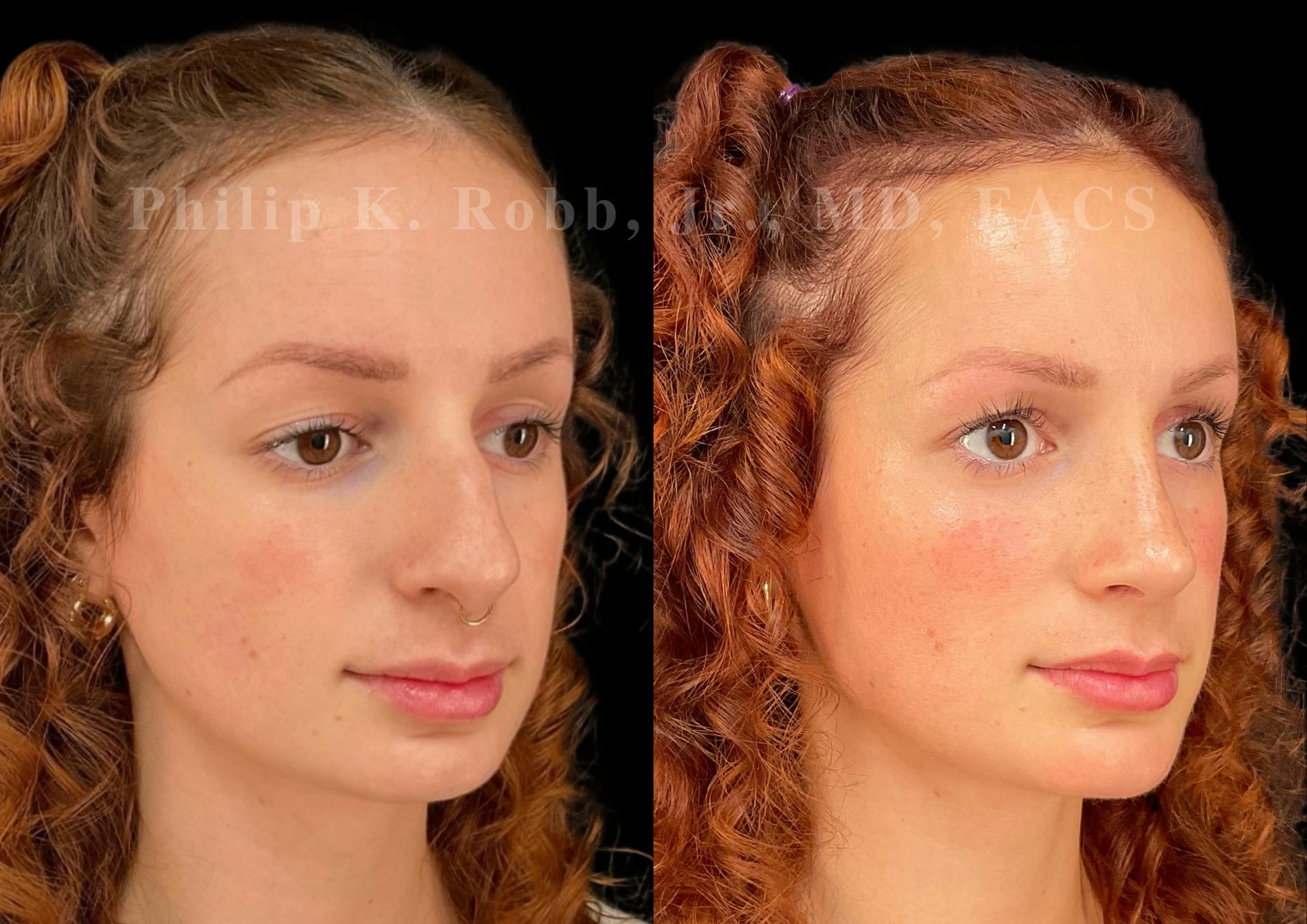 Chin Augmentation Before & After Gallery - Patient 156196 - Image 4