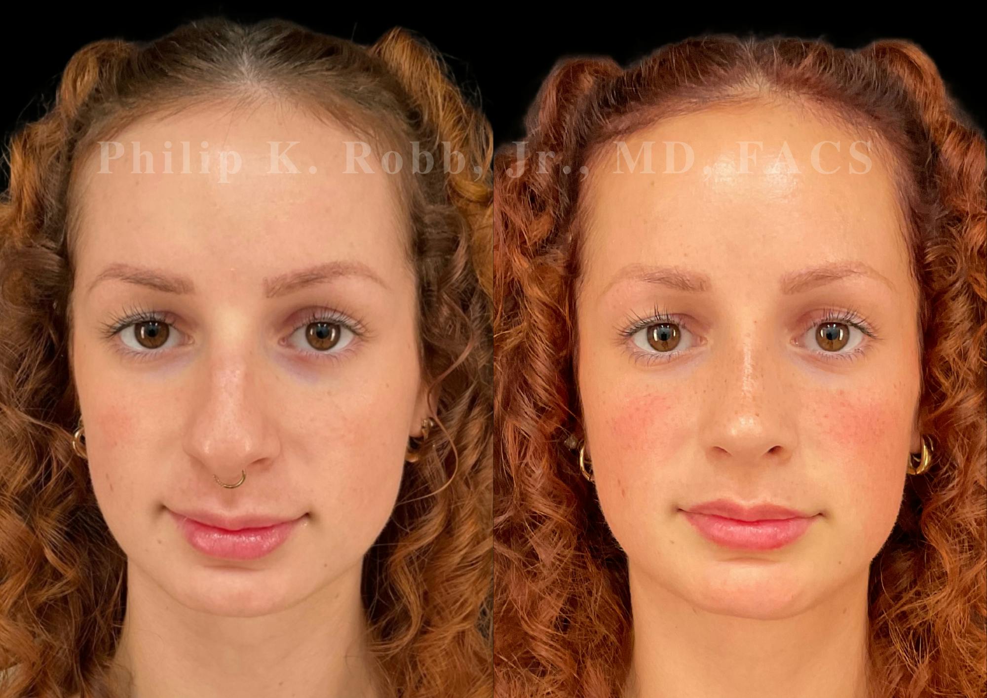 Chin Augmentation Before & After Gallery - Patient 156196 - Image 3