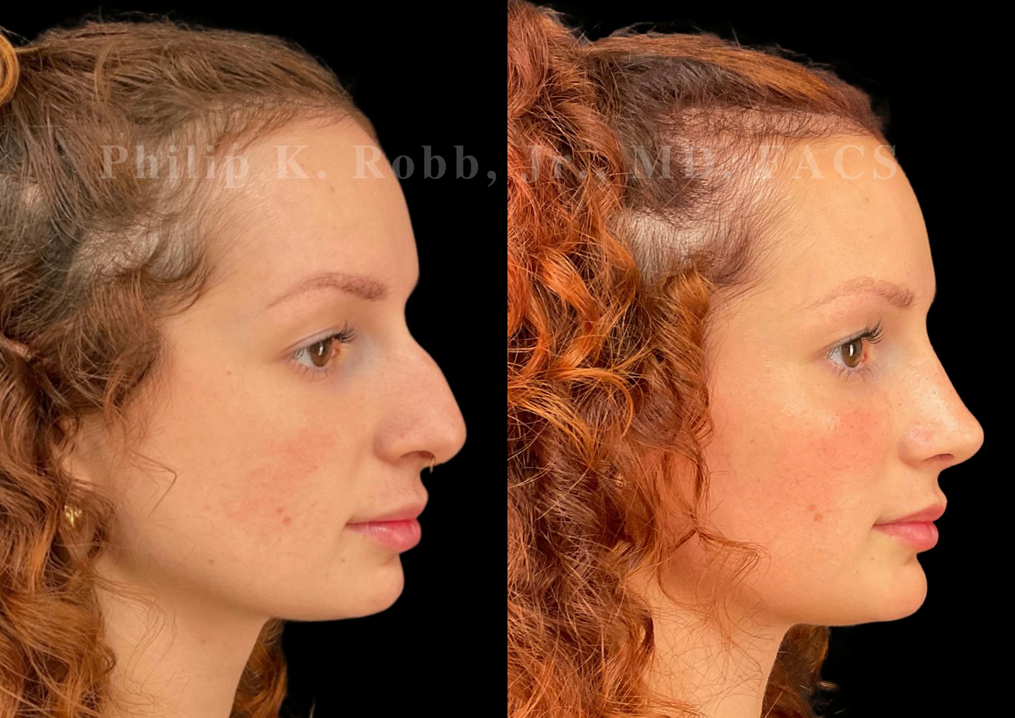 Chin Augmentation Before & After Gallery - Patient 156196 - Image 5