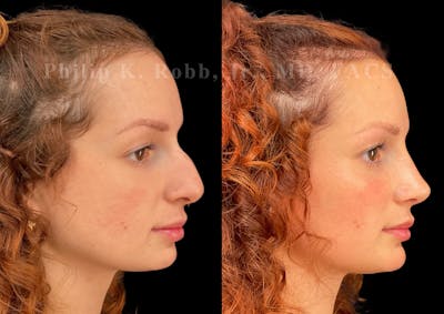 Ultrasonic Rhinoplasty Before & After Gallery - Patient 395975 - Image 1