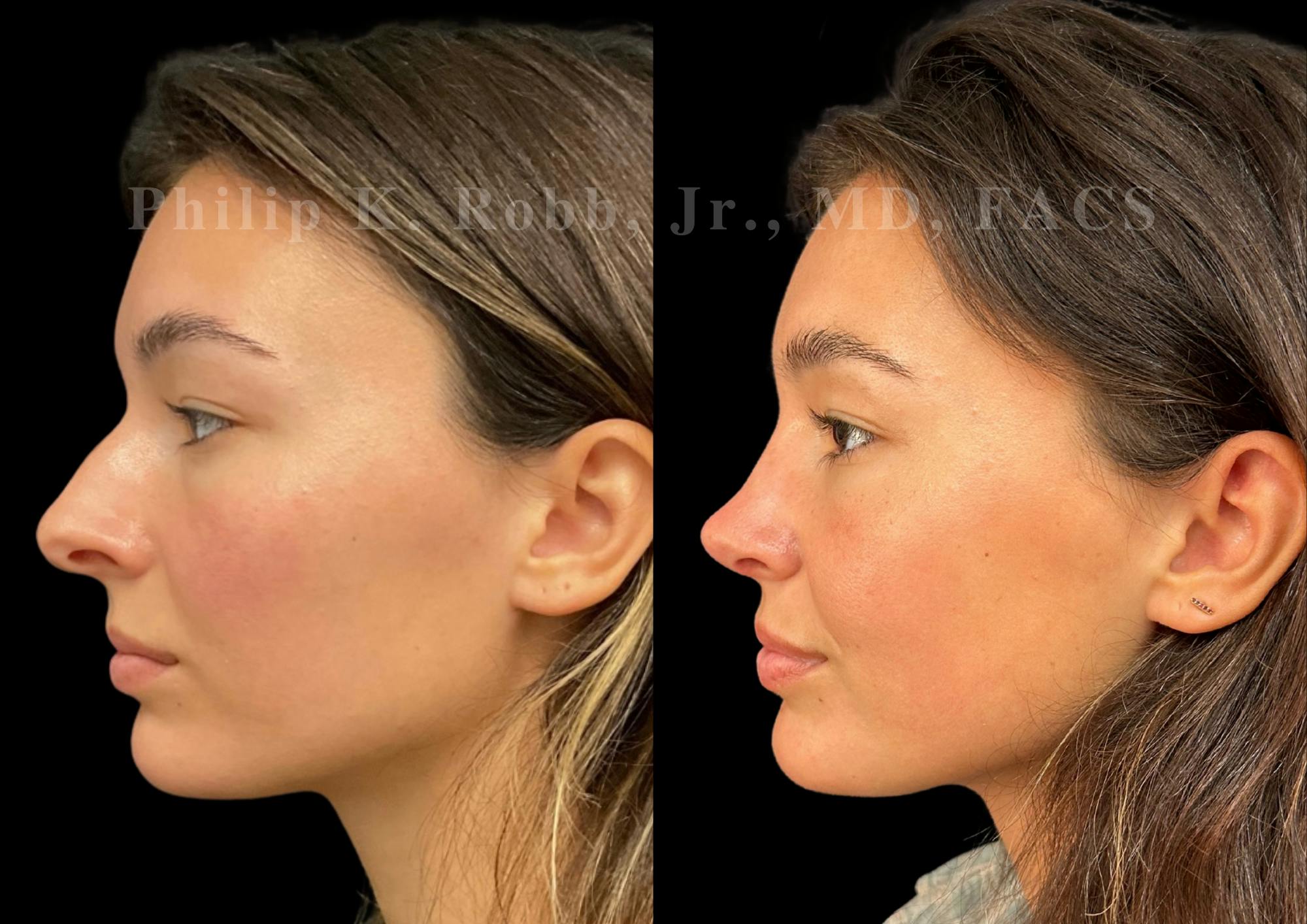 Ultrasonic Rhinoplasty Before & After Gallery - Patient 334028 - Image 5