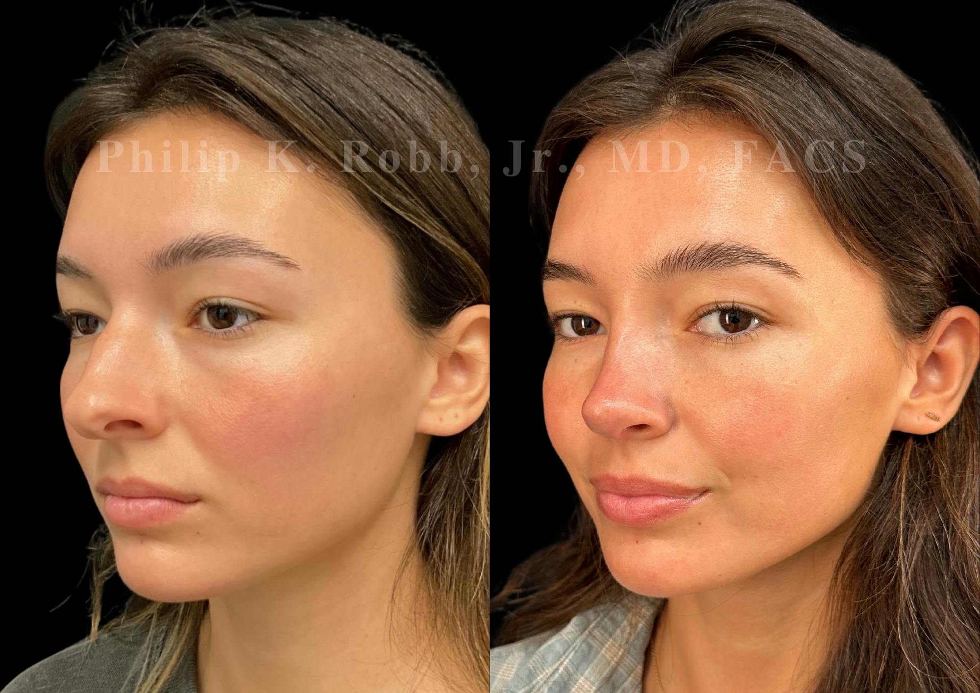Ultrasonic Rhinoplasty Before & After Gallery - Patient 334028 - Image 4