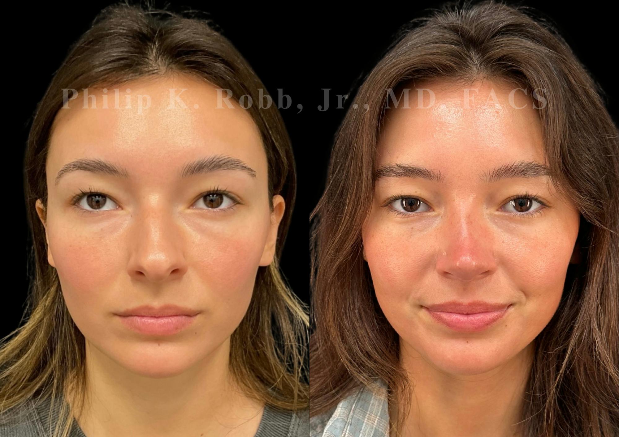 Ultrasonic Rhinoplasty Before & After Gallery - Patient 334028 - Image 3