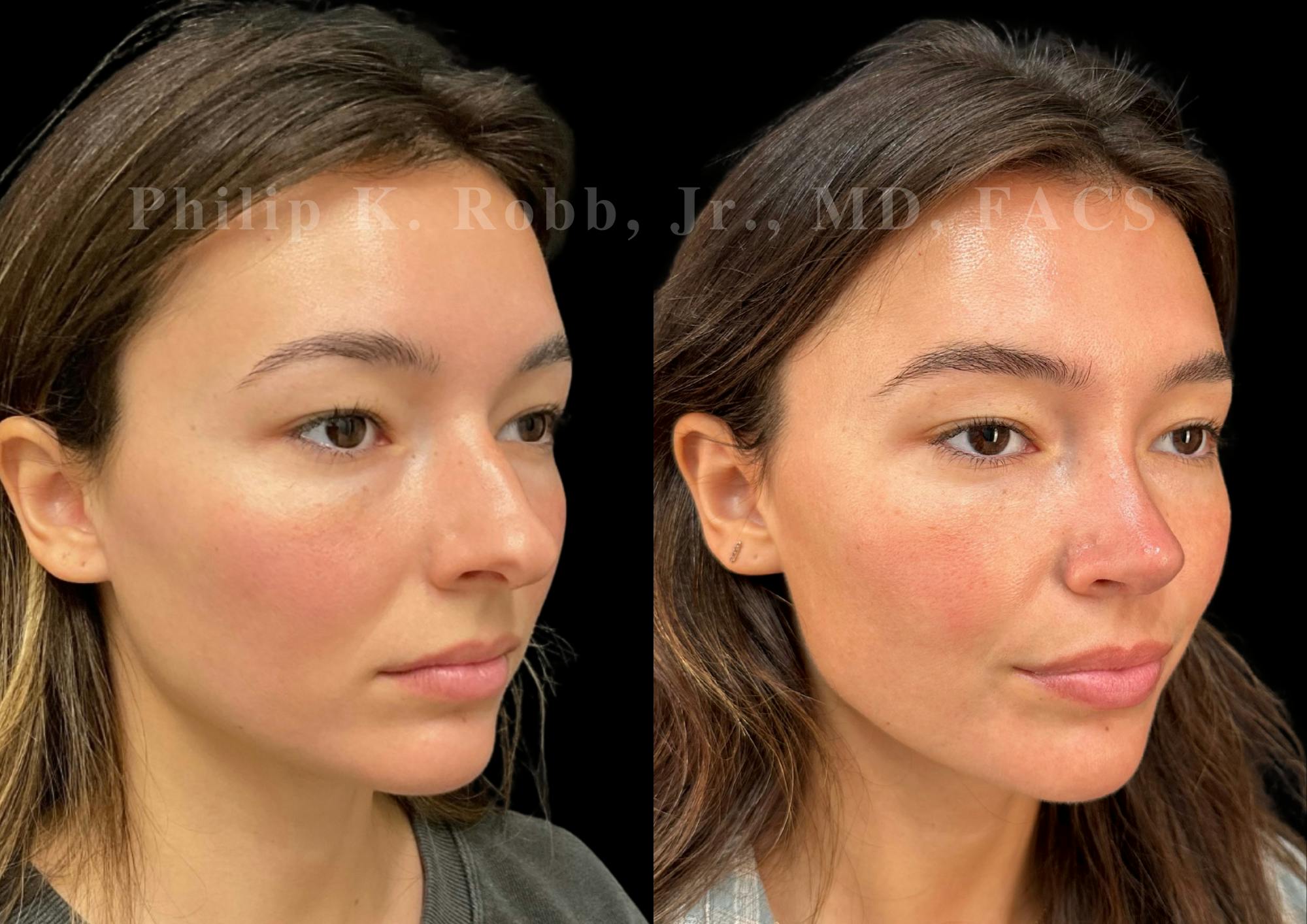 Ultrasonic Rhinoplasty Before & After Gallery - Patient 334028 - Image 2
