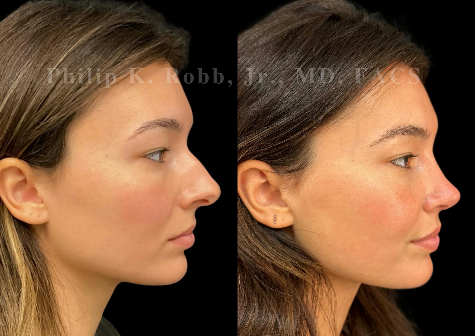 Ultrasonic Rhinoplasty Before & After Gallery - Patient 334028 - Image 1