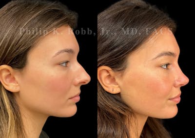 Ultrasonic Rhinoplasty Before & After Gallery - Patient 334028 - Image 1
