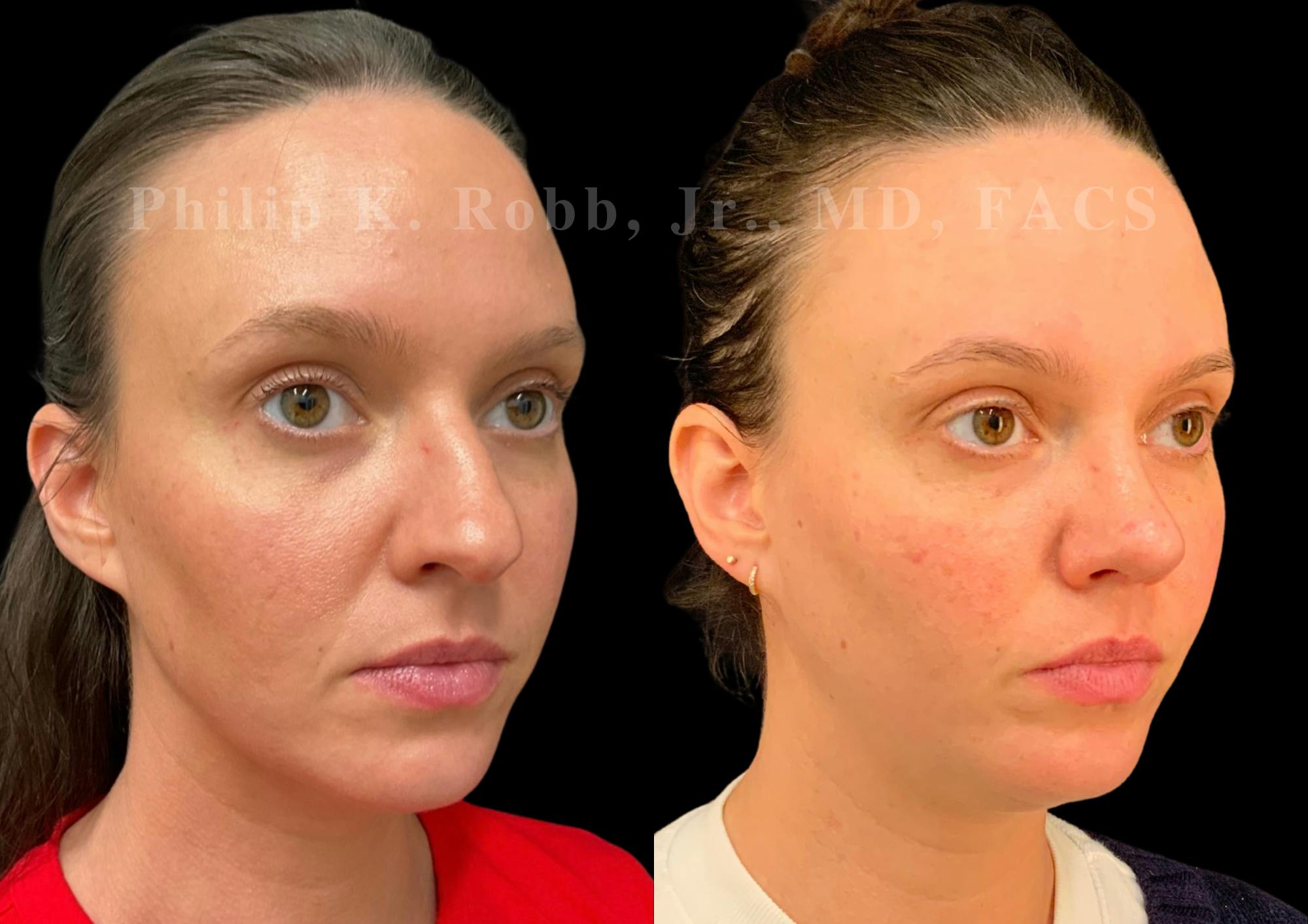 Ultrasonic Rhinoplasty Before & After Gallery - Patient 305268 - Image 2