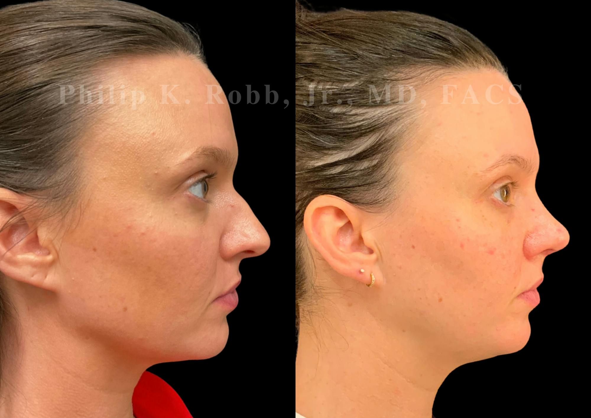 Ultrasonic Rhinoplasty Before & After Gallery - Patient 305268 - Image 1