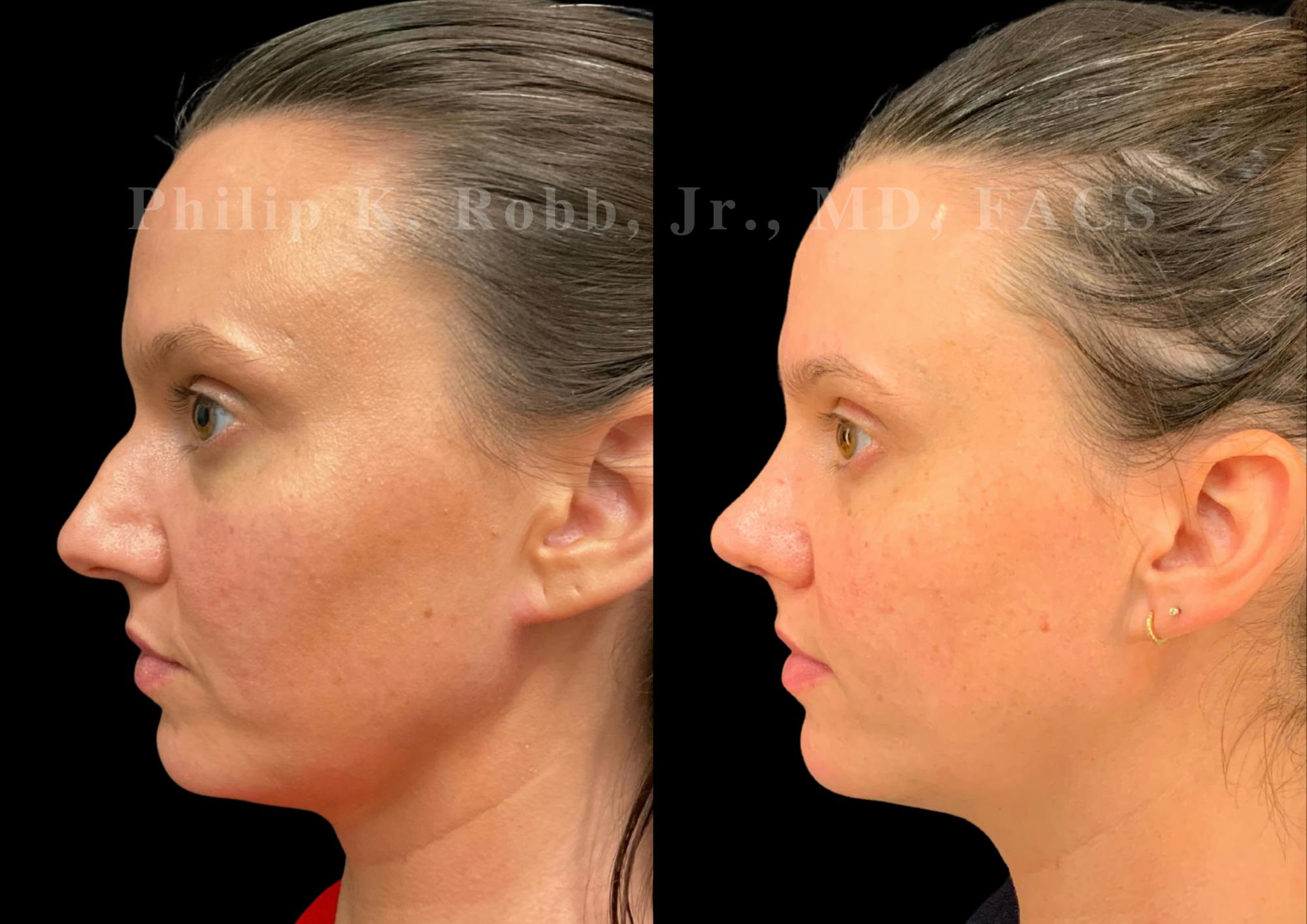 Ultrasonic Rhinoplasty Before & After Gallery - Patient 305268 - Image 5
