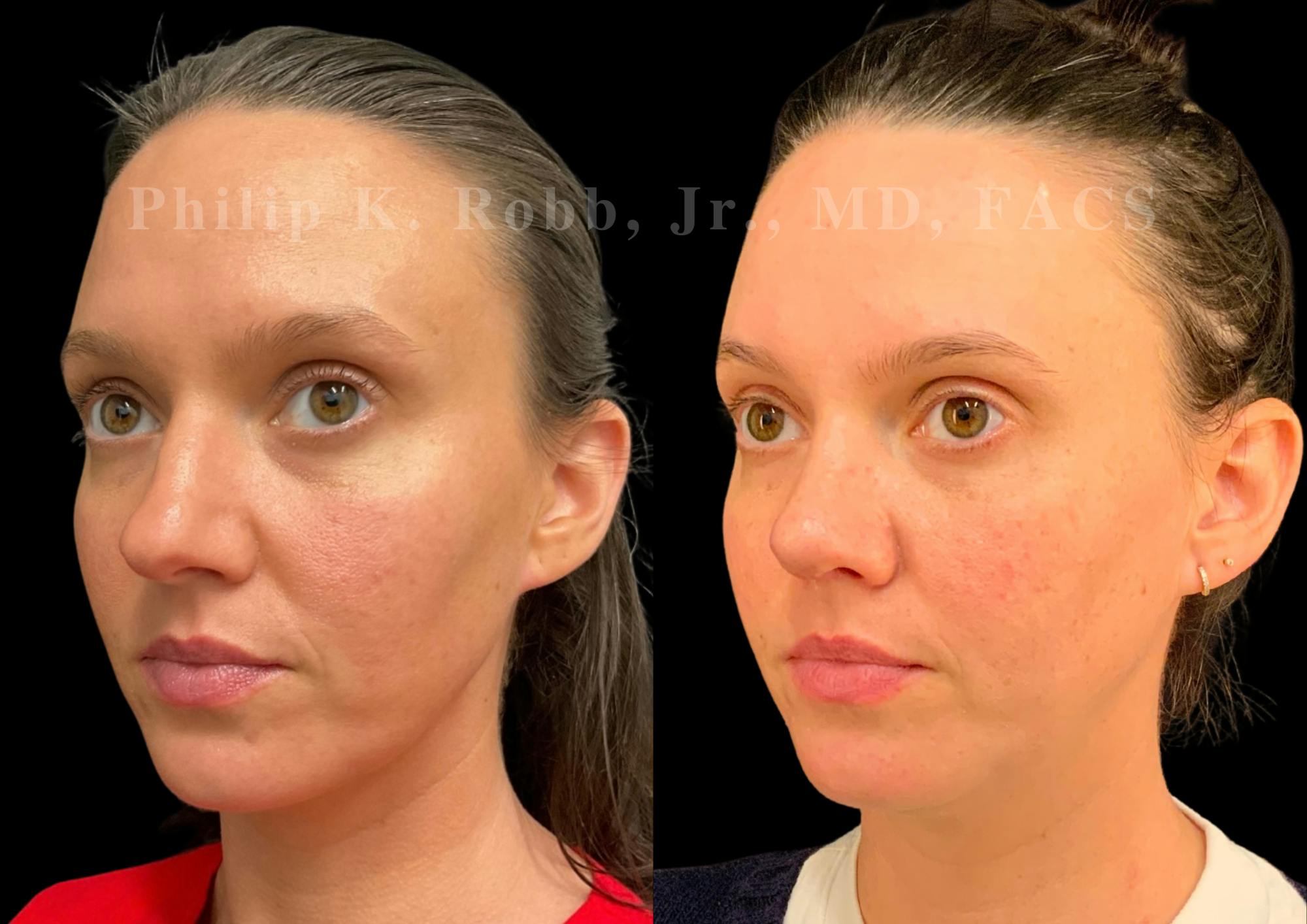 Ultrasonic Rhinoplasty Before & After Gallery - Patient 305268 - Image 4