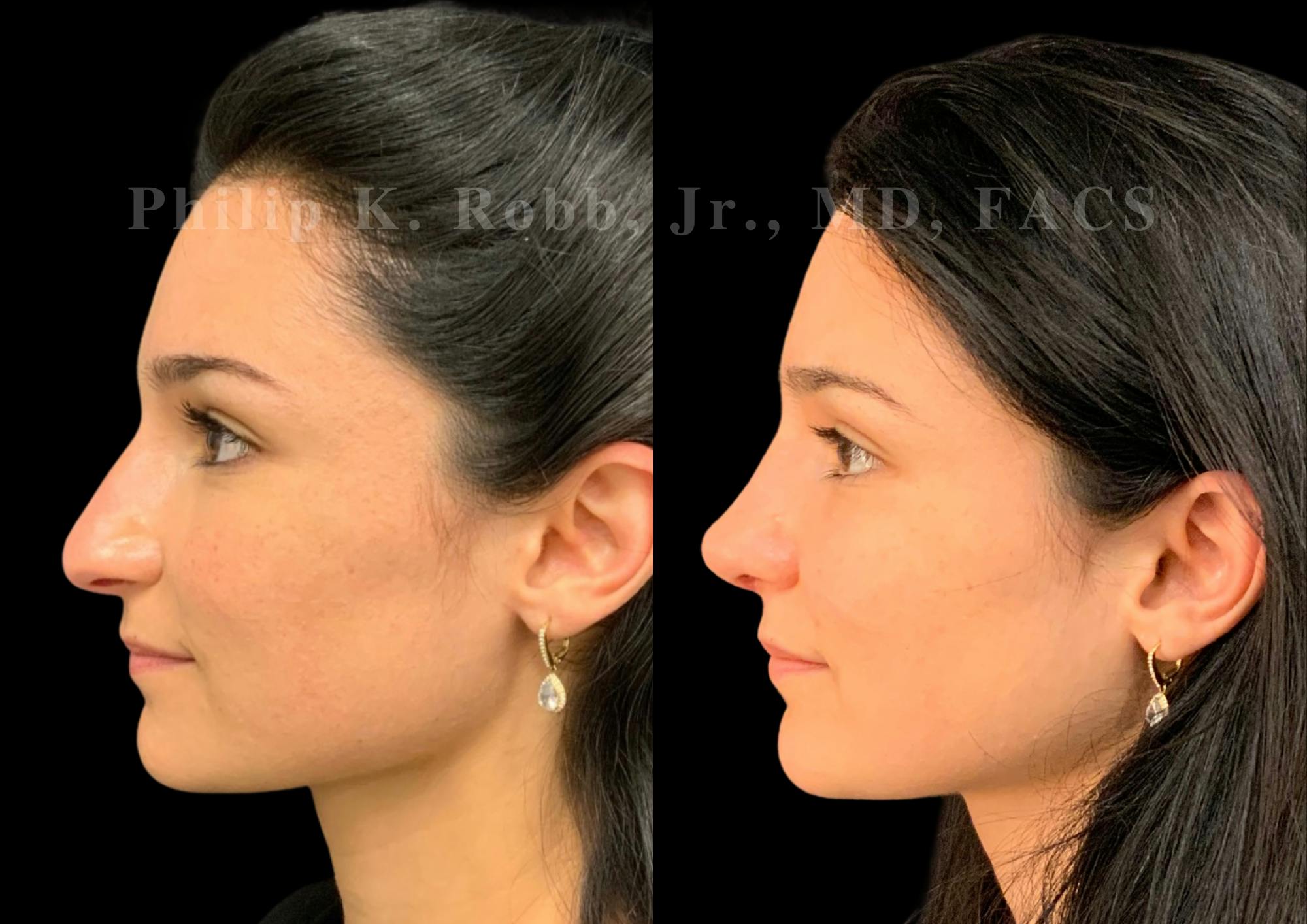 Ultrasonic Rhinoplasty Before & After Gallery - Patient 287059 - Image 5