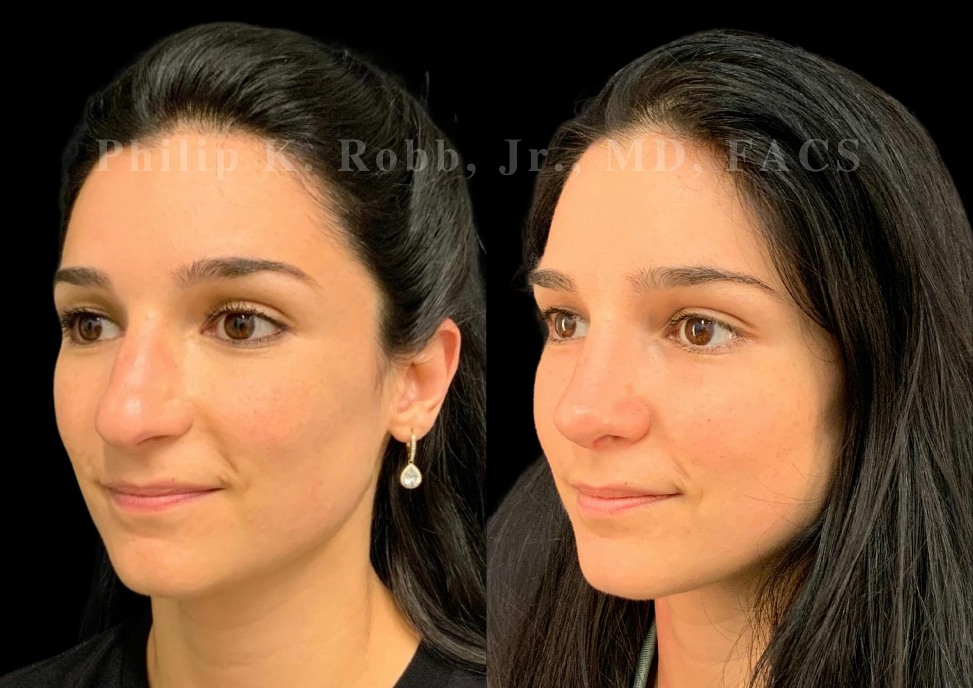 Ultrasonic Rhinoplasty Before & After Gallery - Patient 287059 - Image 4