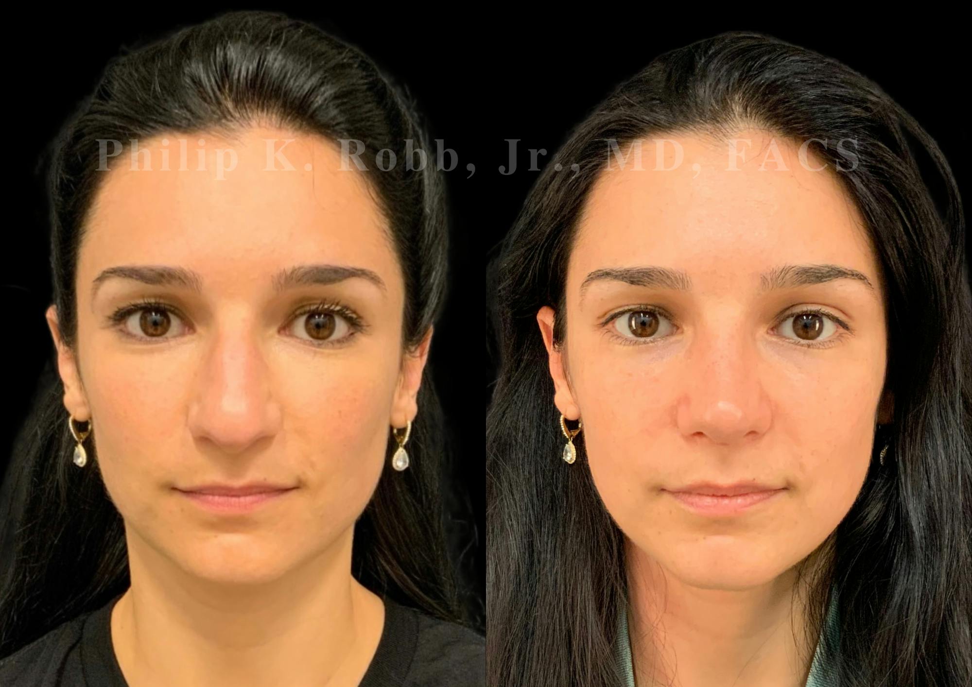 Ultrasonic Rhinoplasty Before & After Gallery - Patient 287059 - Image 3