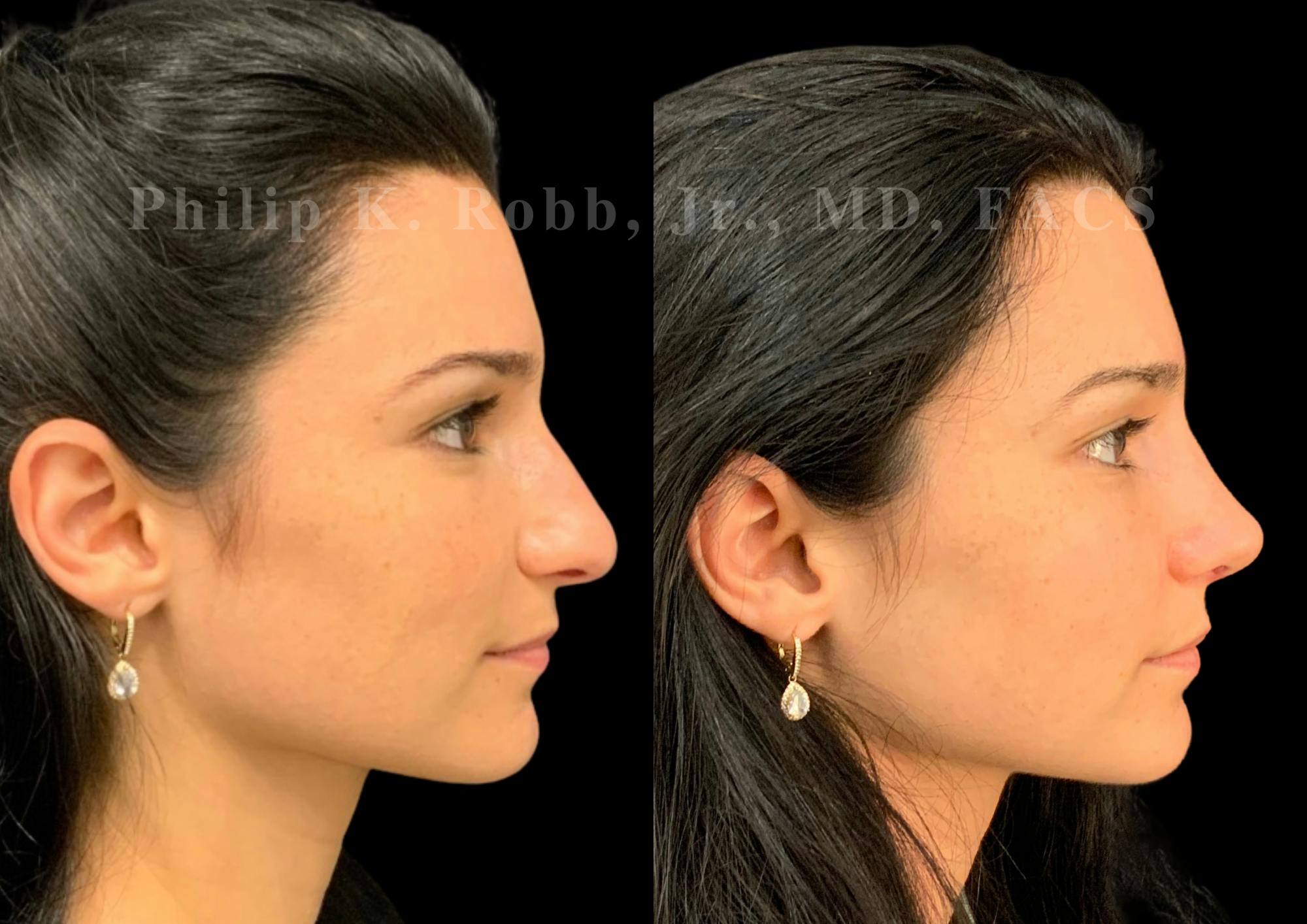 Ultrasonic Rhinoplasty Before & After Gallery - Patient 287059 - Image 1