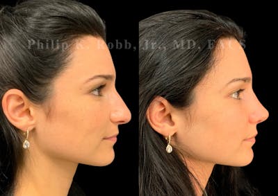 Ultrasonic Rhinoplasty Before & After Gallery - Patient 287059 - Image 1