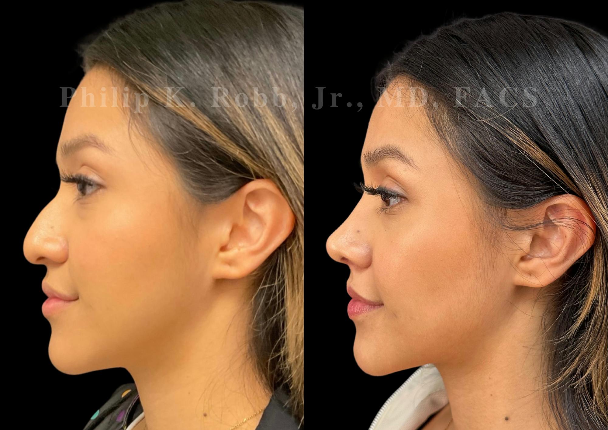 Ultrasonic Rhinoplasty Before & After Gallery - Patient 371038 - Image 5
