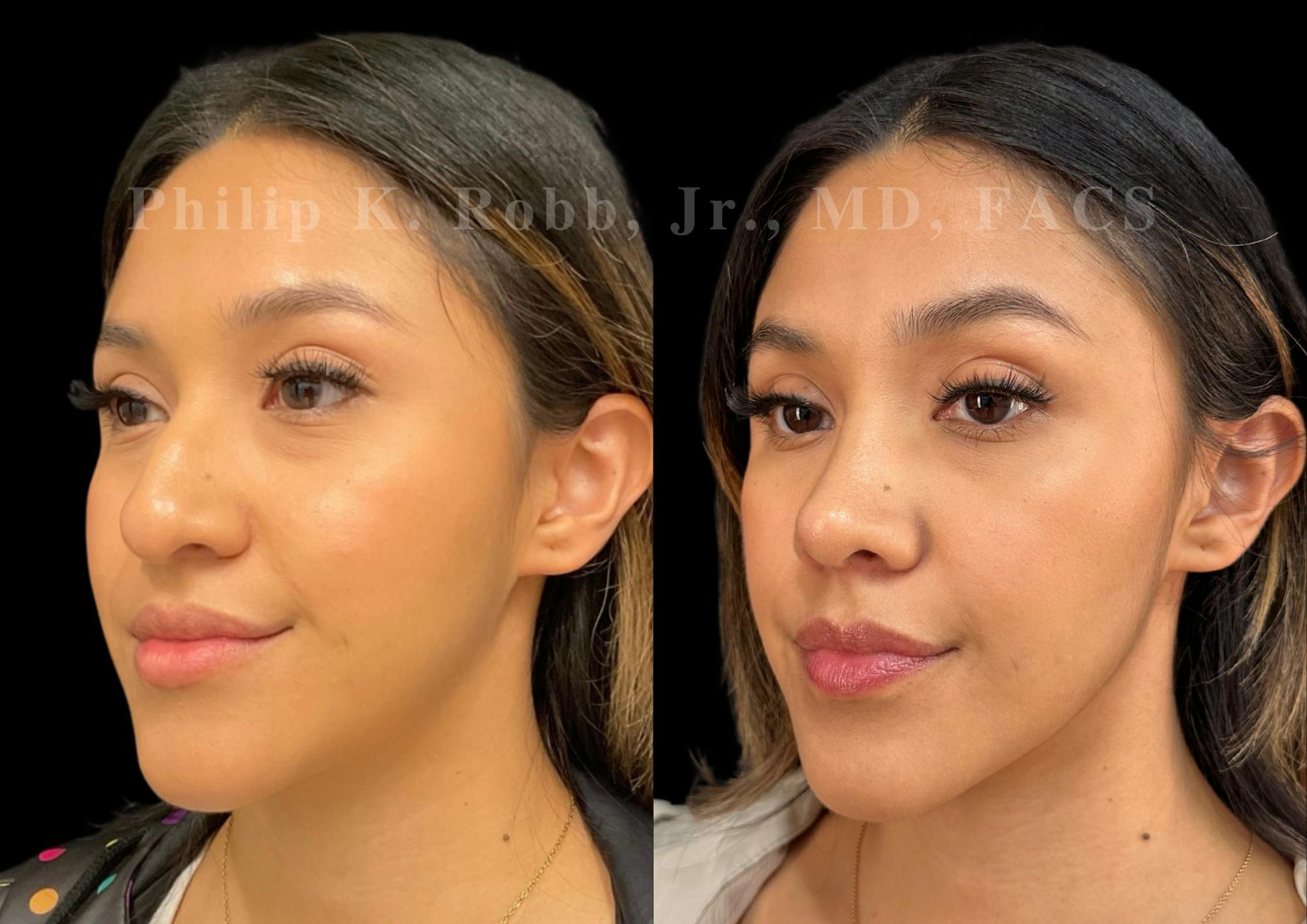 Ultrasonic Rhinoplasty Before & After Gallery - Patient 371038 - Image 4