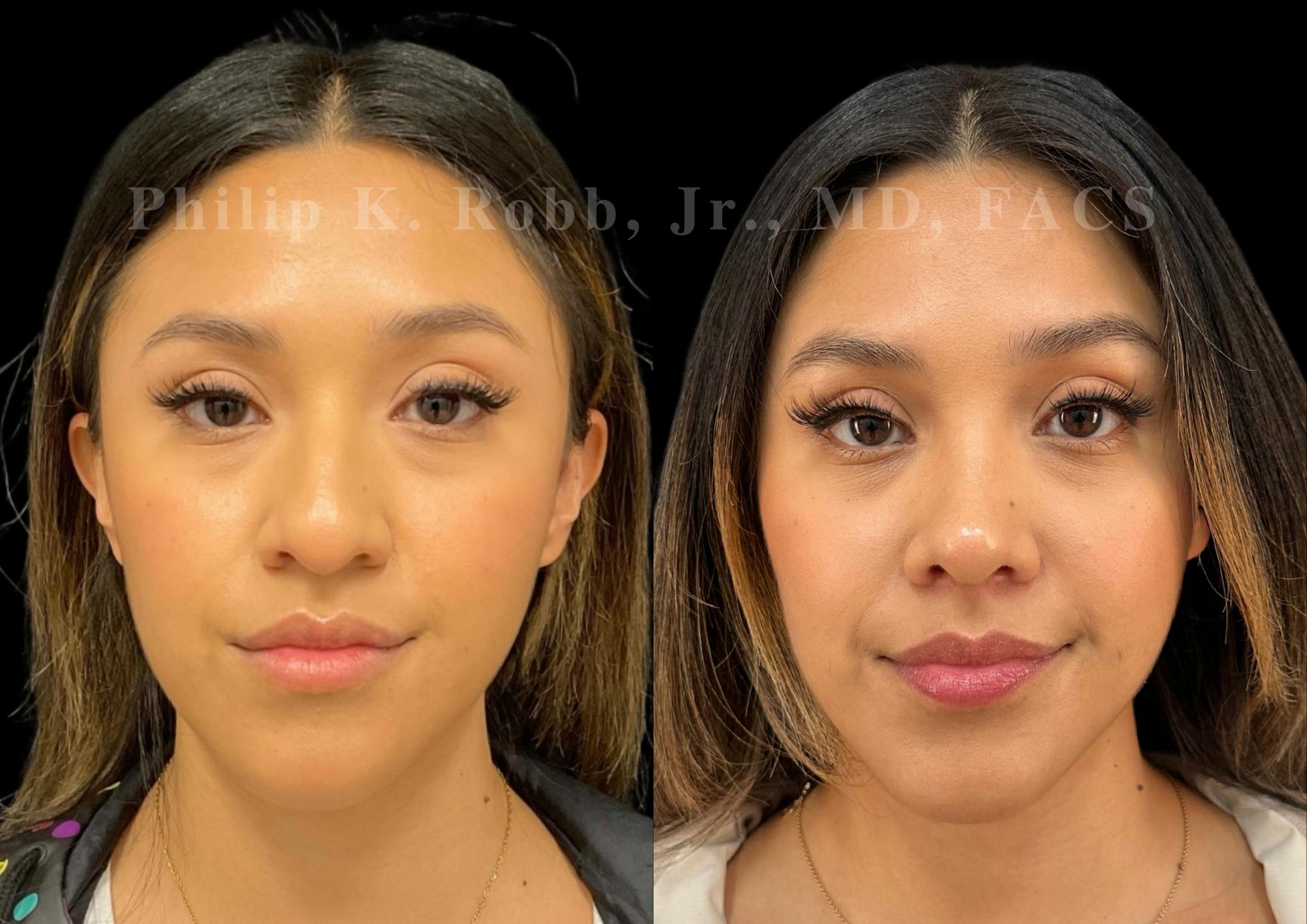 Ultrasonic Rhinoplasty Before & After Gallery - Patient 371038 - Image 3