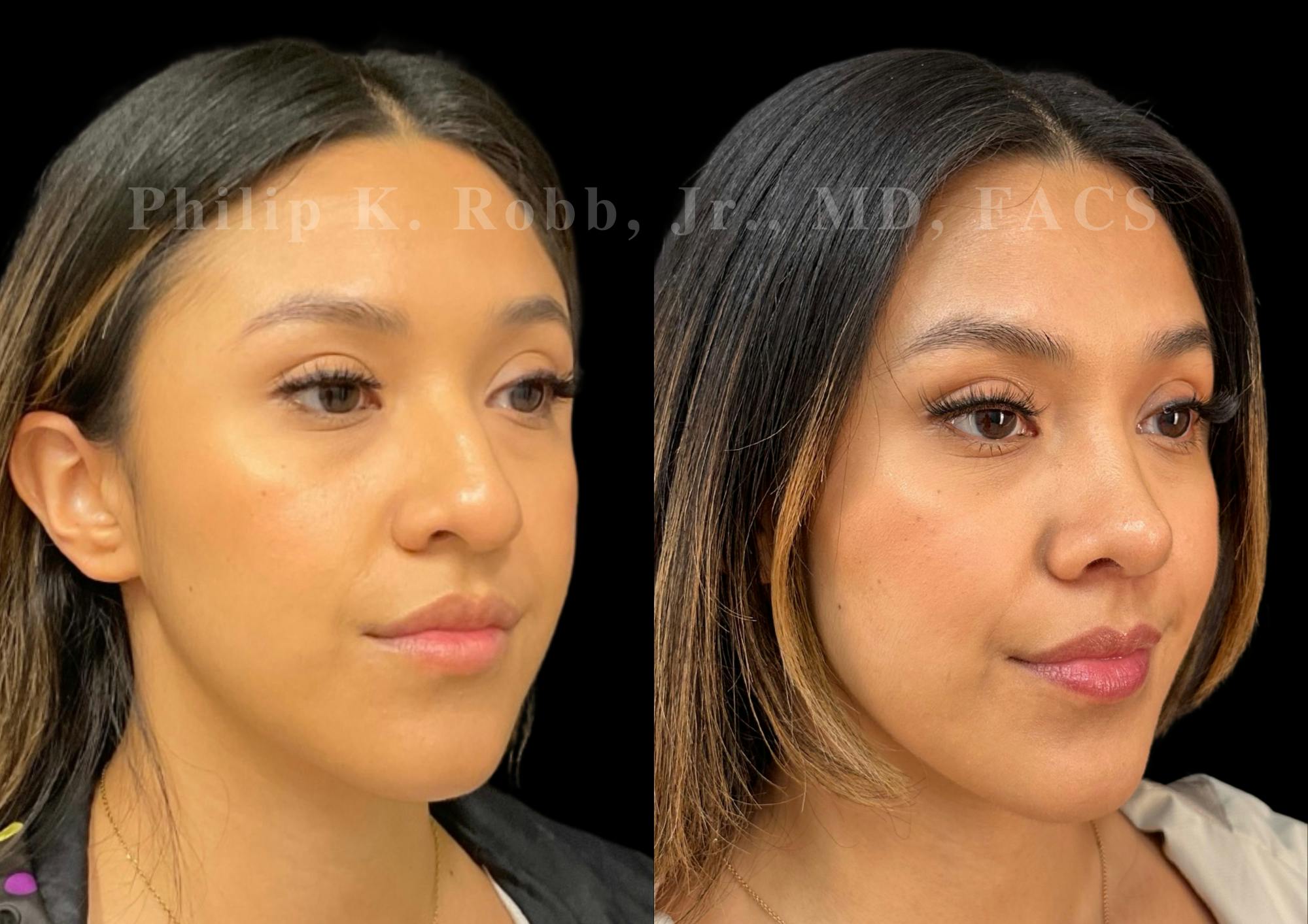 Ultrasonic Rhinoplasty Before & After Gallery - Patient 371038 - Image 2
