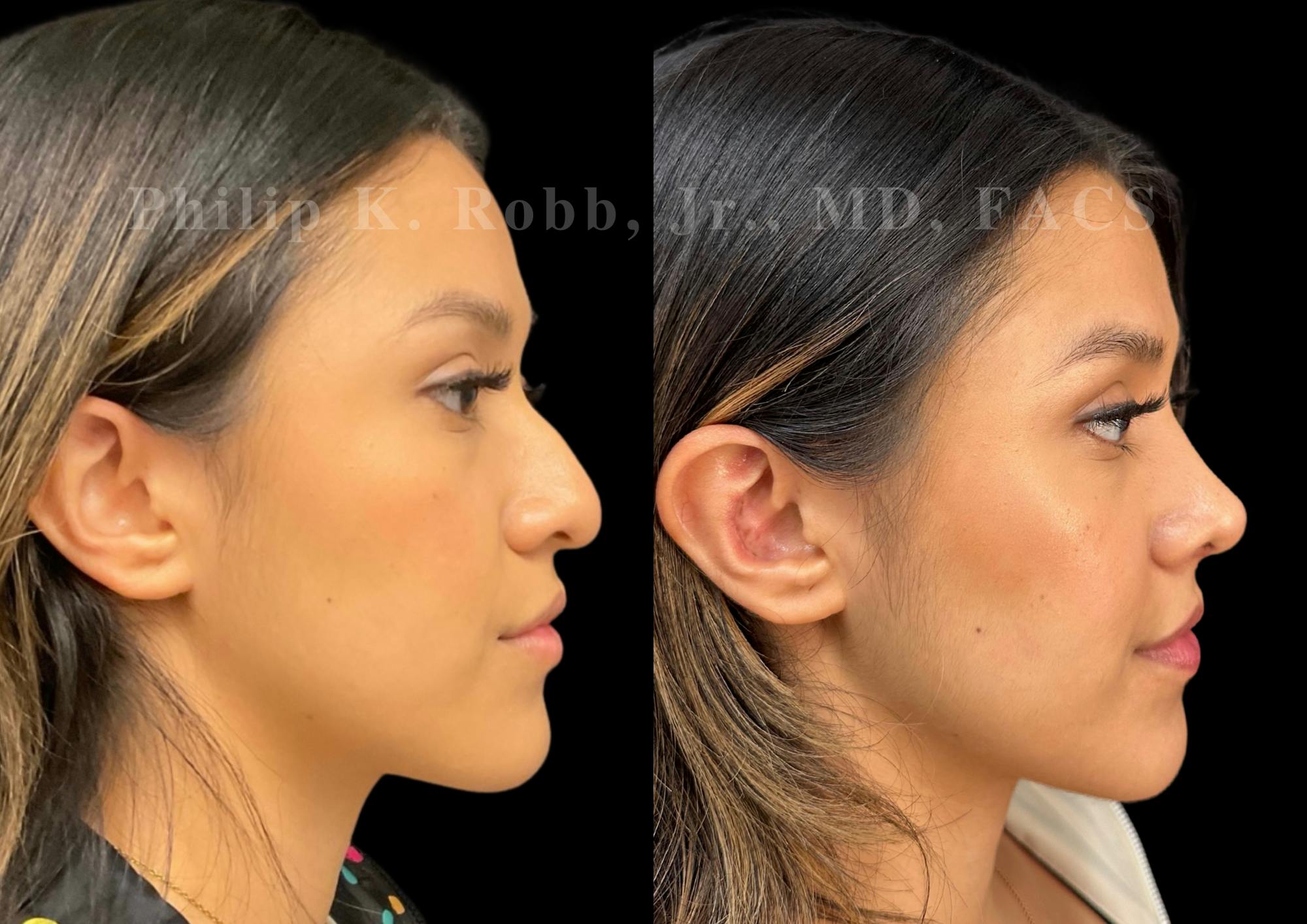 Ultrasonic Rhinoplasty Before & After Gallery - Patient 371038 - Image 1