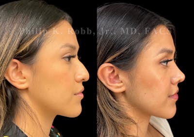 Ultrasonic Rhinoplasty Before & After Gallery - Patient 371038 - Image 1